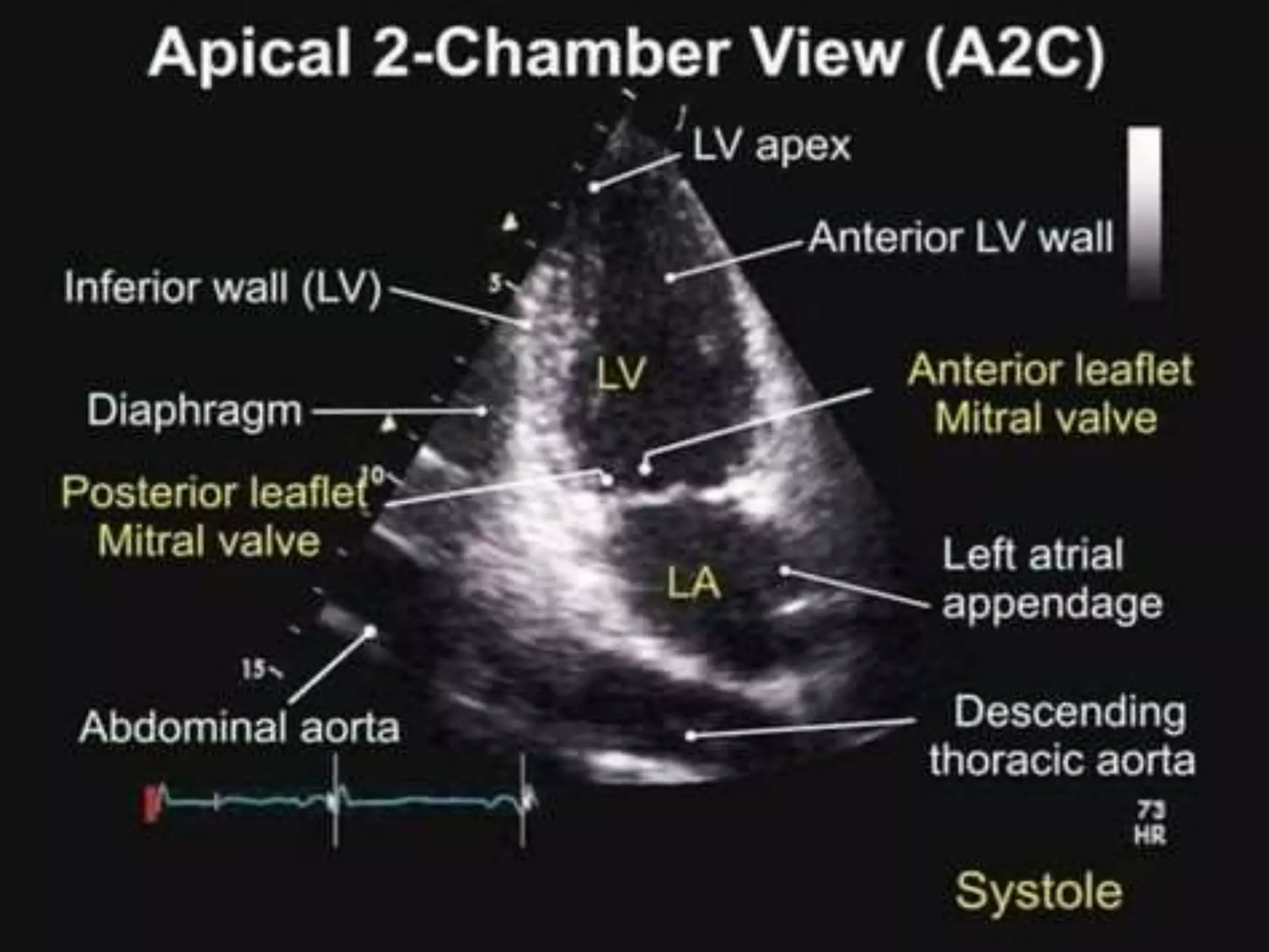 Ase Chamber Quant Basics of echo Cardiac Structure, Chamber quantifications & Artifacts.pptx
