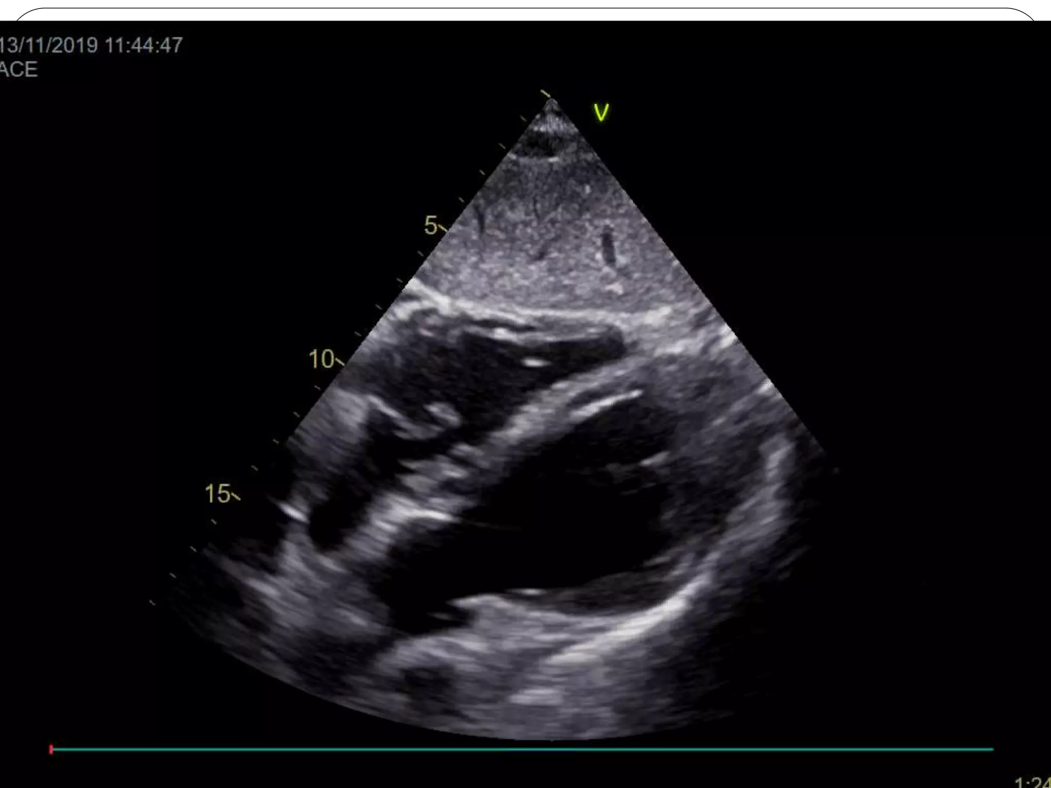 Basics of echo Cardiac Structure, Chamber quantifications & Artifacts.pptx