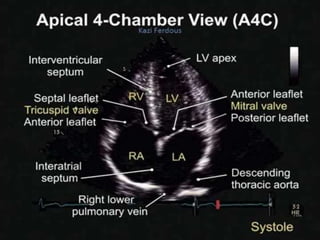 Ase Chamber Quant Basics of echo Cardiac Structure, Chamber quantifications & Artifacts.pptx