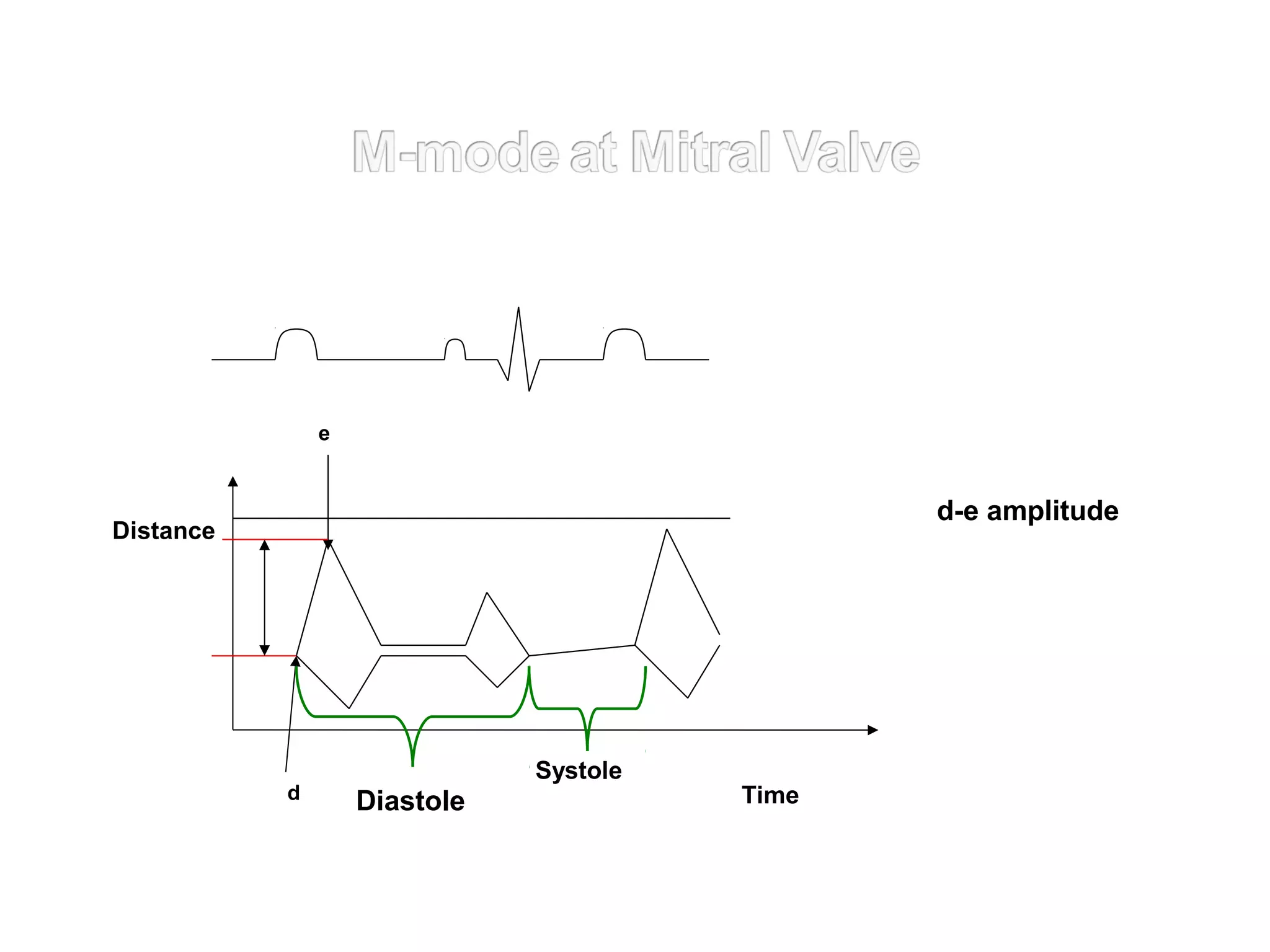 Systole
Diastole
e
d Time
Distance
d-e amplitude
 