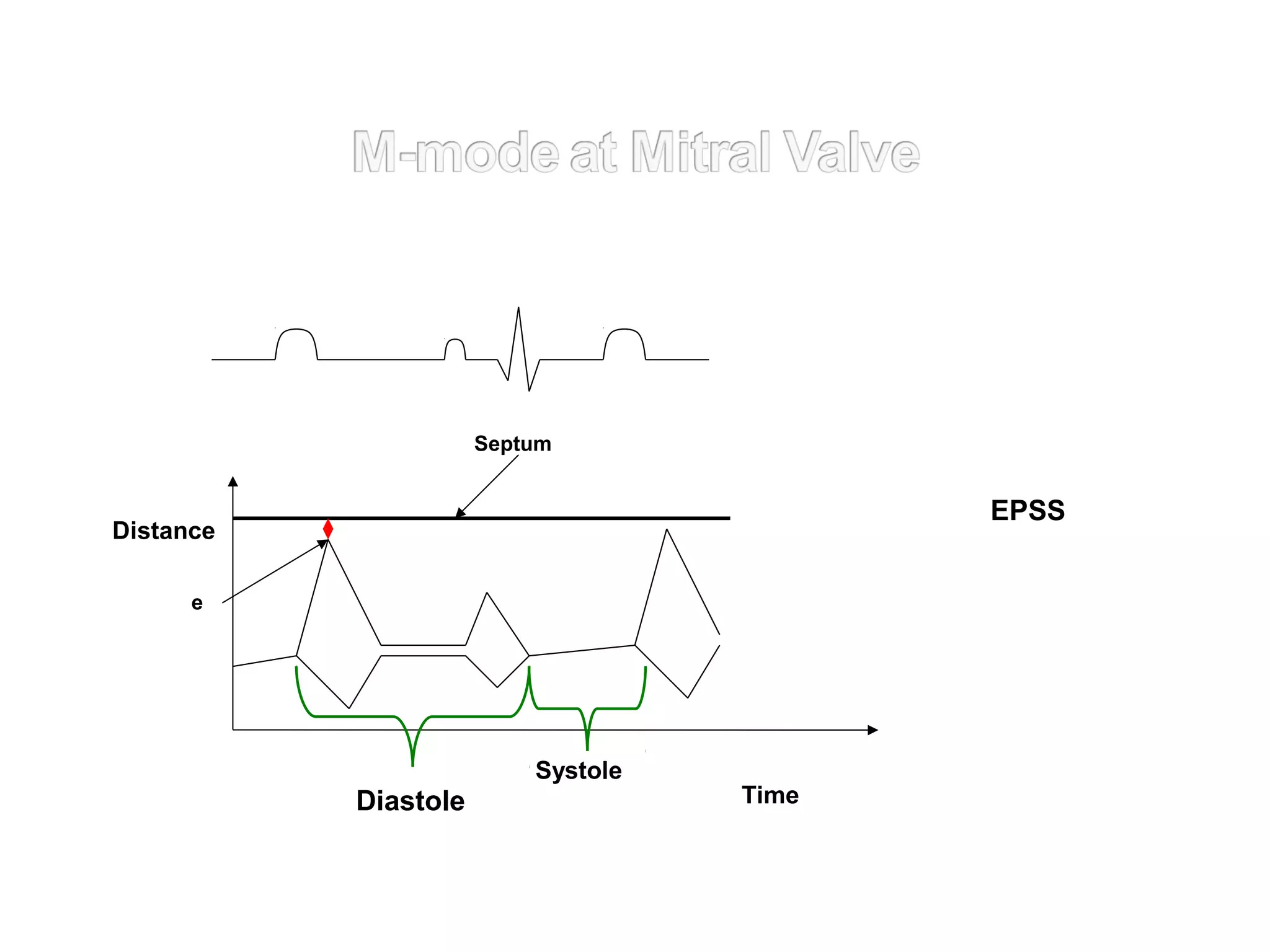 Systole
Diastole
Septum
e
Time
Distance
EPSS
 
