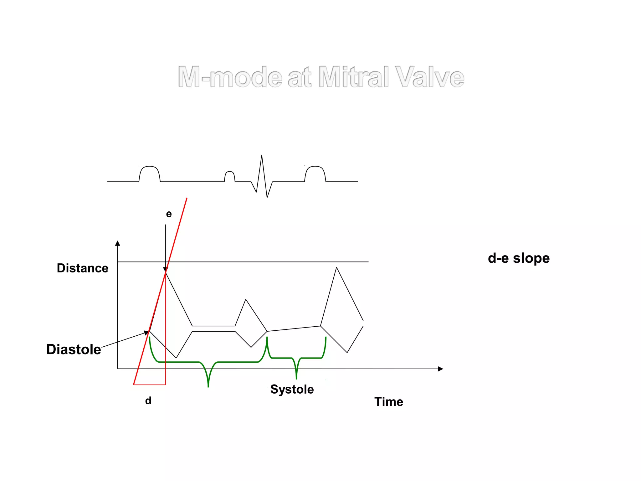 Systole
Diastole
e
d Time
Distance
d-e slope
 
