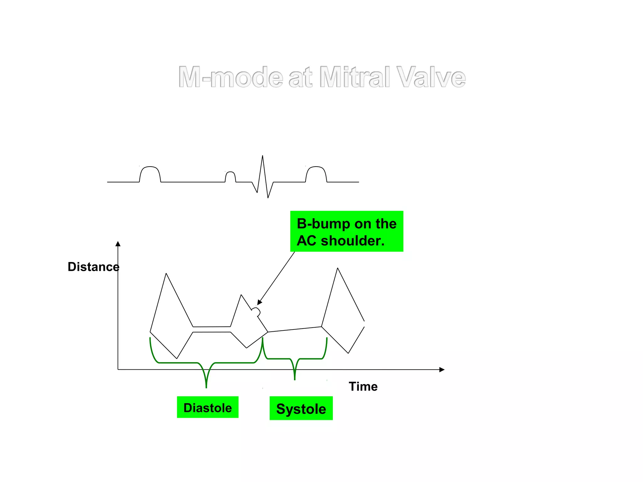 Distance
SystoleDiastole
Time
B-bump on the
AC shoulder.
 