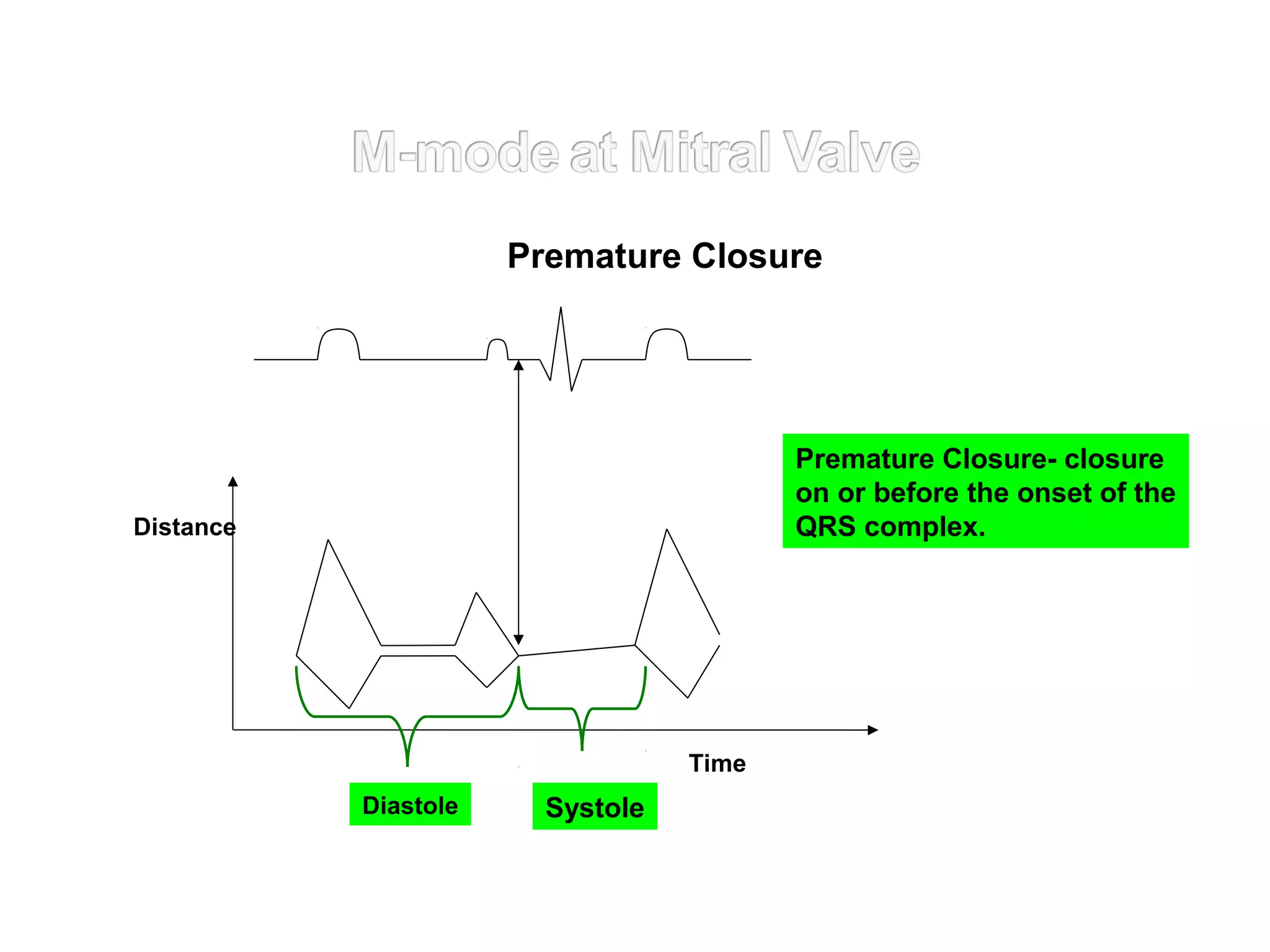 Distance
SystoleDiastole
Time
Premature Closure
Premature Closure- closure
on or before the onset of the
QRS complex.
 