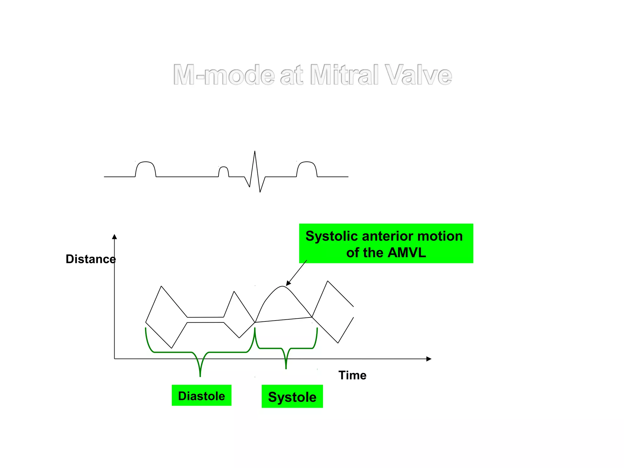 Distance
SystoleDiastole
Time
Systolic anterior motion
of the AMVL
 