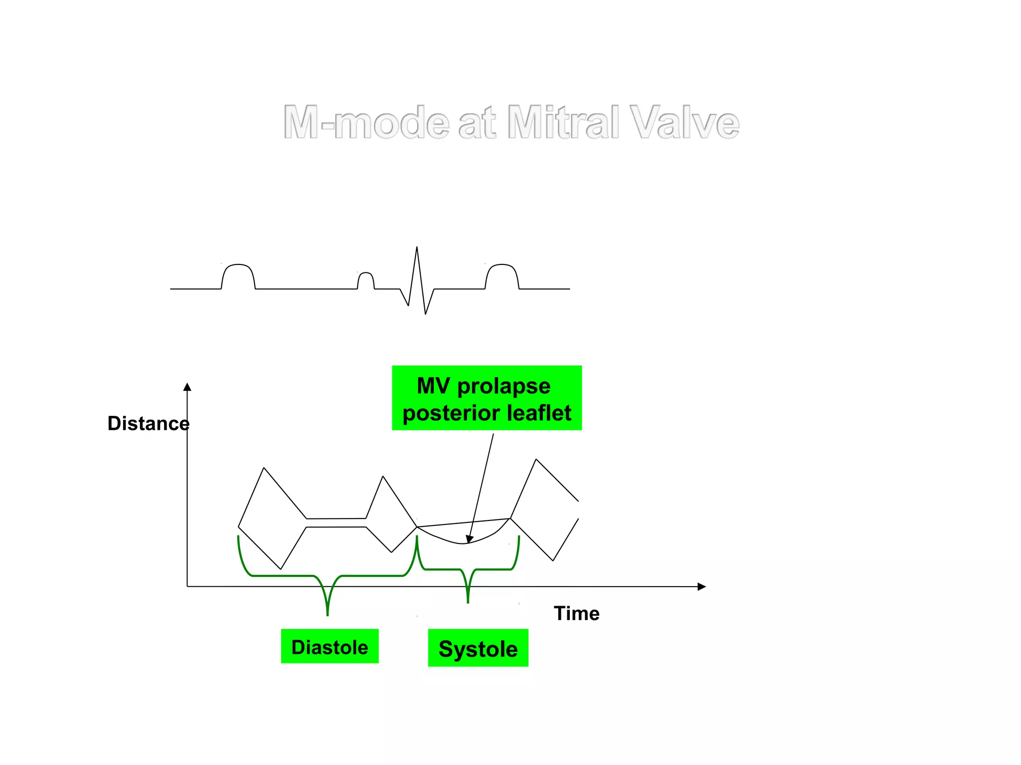 Distance
SystoleDiastole
Time
MV prolapse
posterior leaflet
 