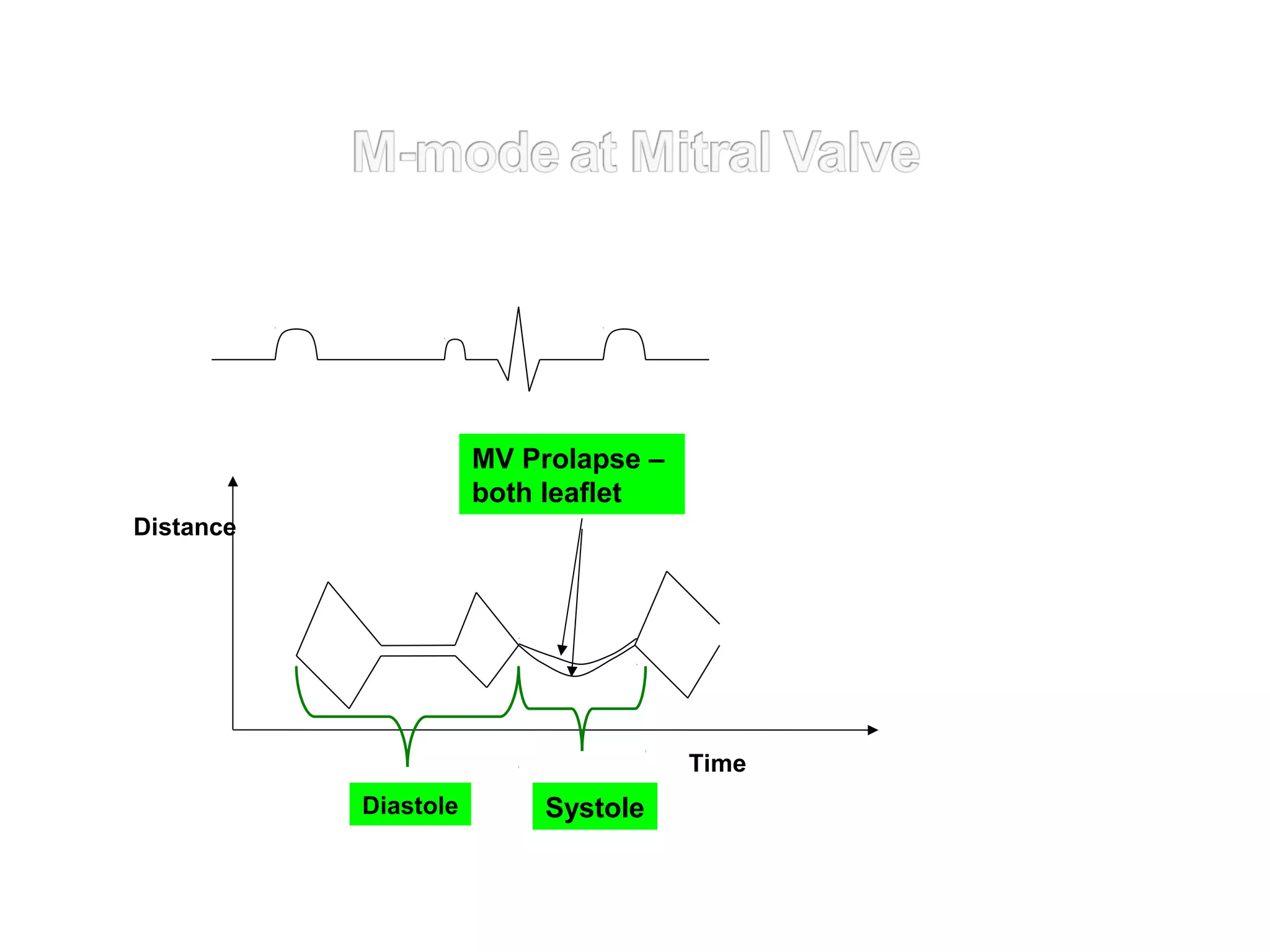 Distance
SystoleDiastole
Time
MV Prolapse –
both leaflet
 