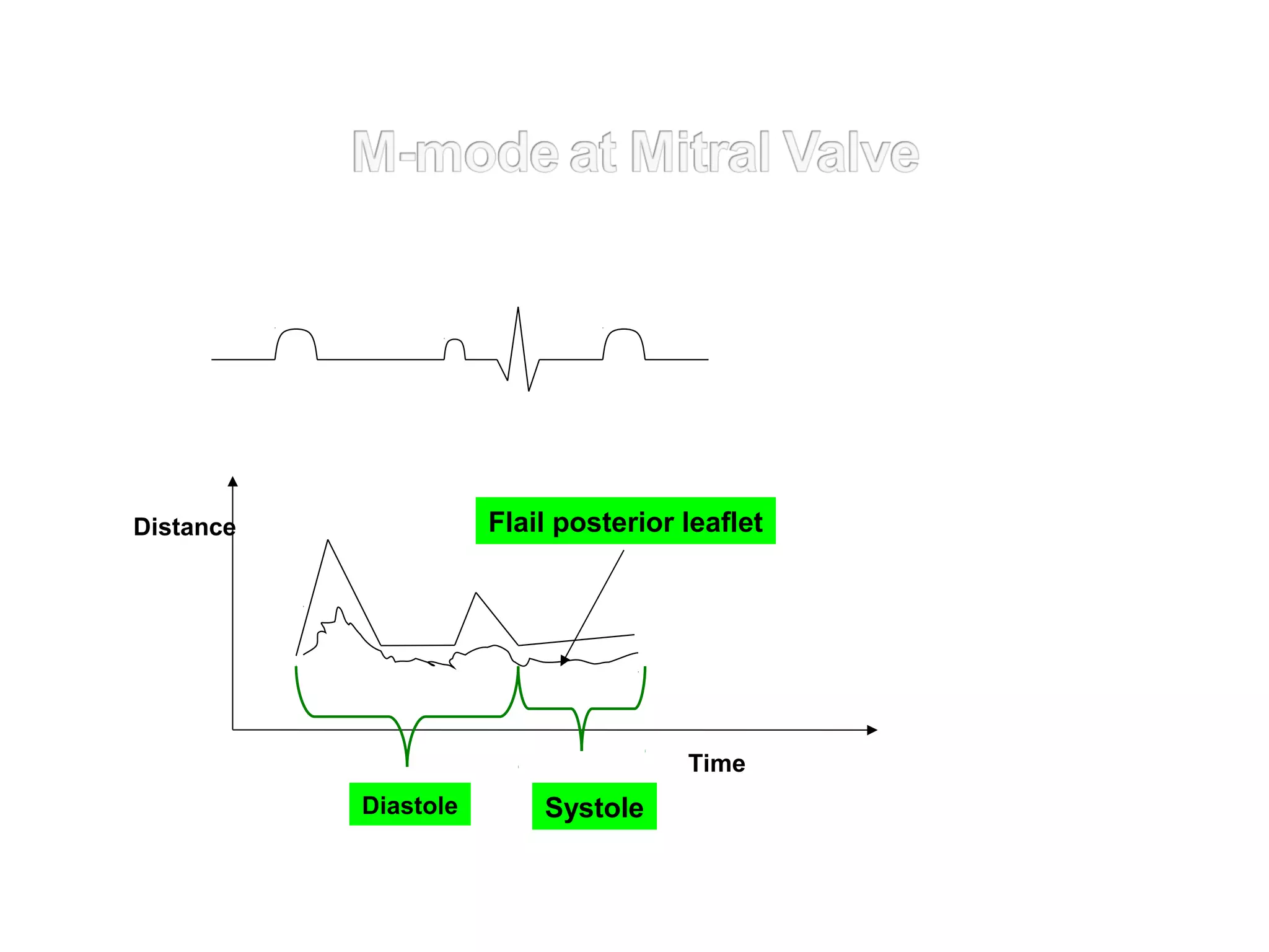 Distance
SystoleDiastole
Time
Flail posterior leaflet
 