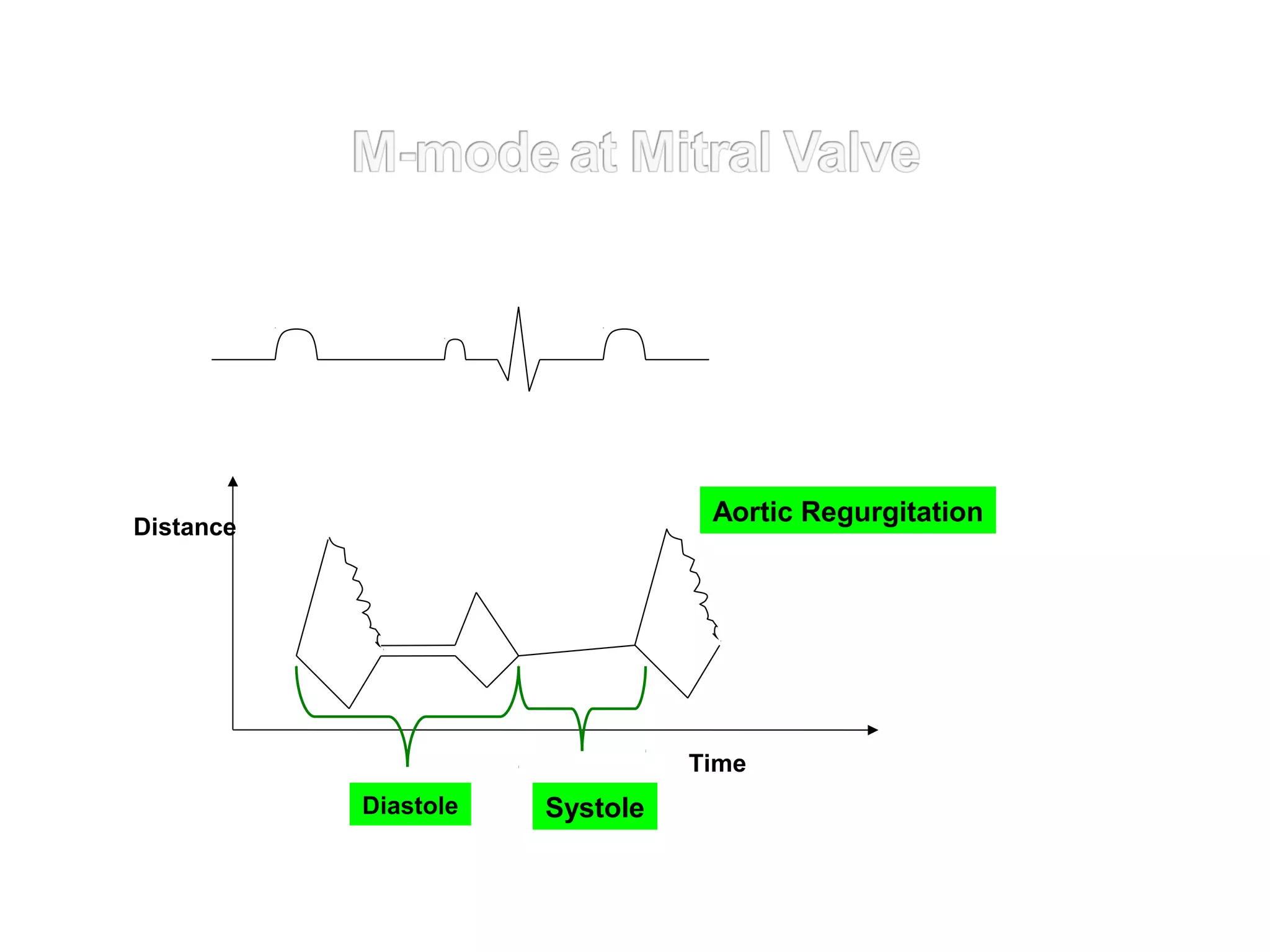 Distance
SystoleDiastole
Time
Aortic Regurgitation
 