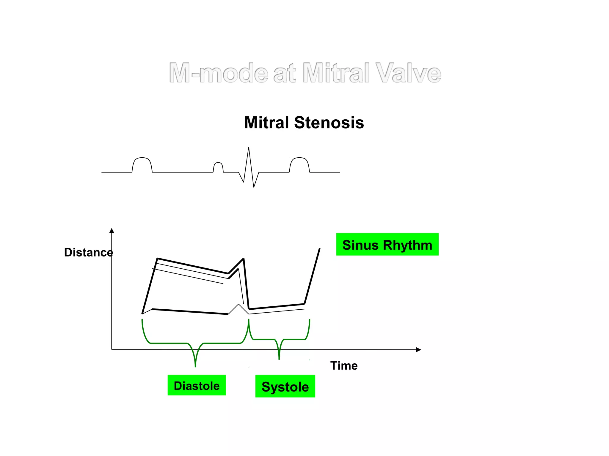 Distance
SystoleDiastole
Time
Sinus Rhythm
Mitral Stenosis
 