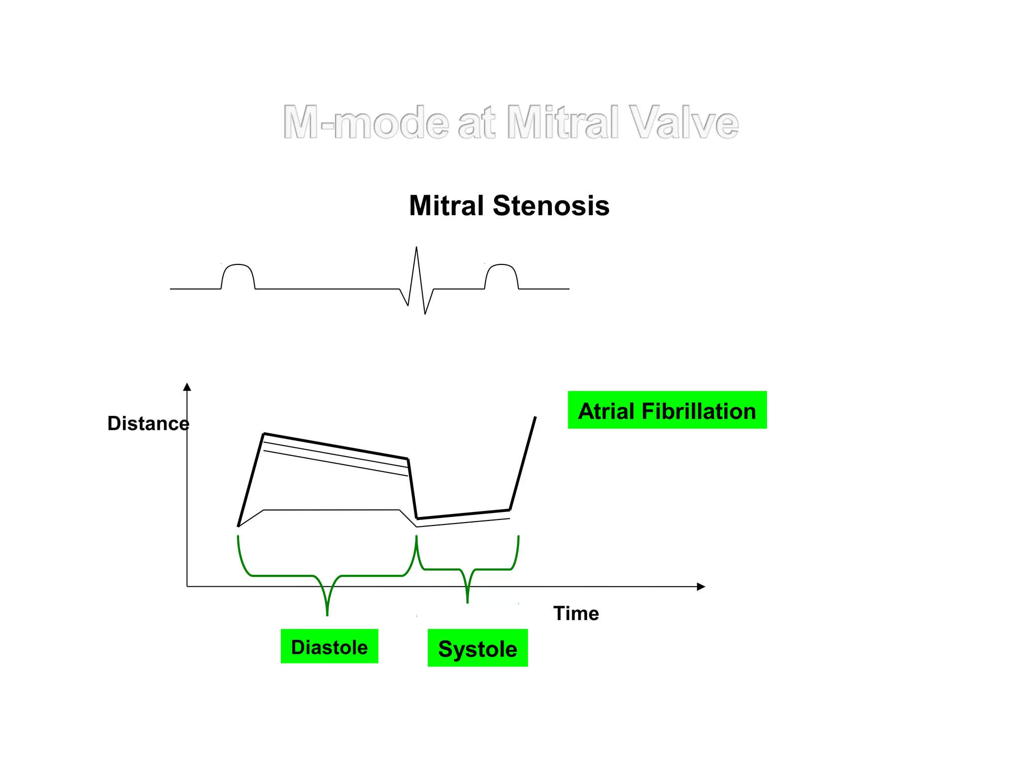 Distance
SystoleDiastole
Time
Atrial Fibrillation
Mitral Stenosis
 