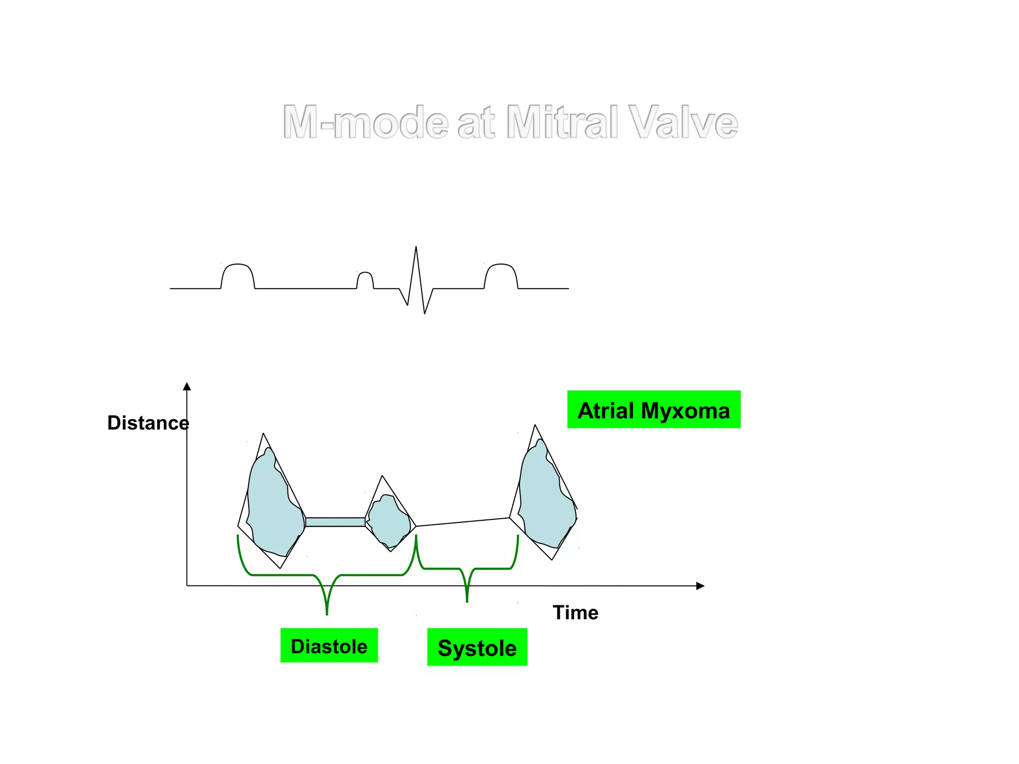 Distance
SystoleDiastole
Time
Atrial Myxoma
 