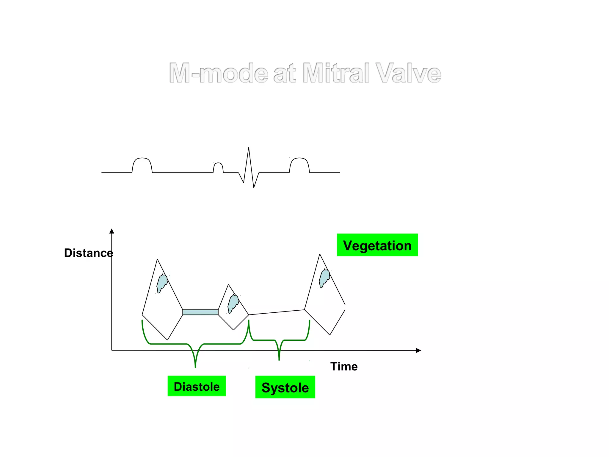 Distance
SystoleDiastole
Time
Vegetation
 