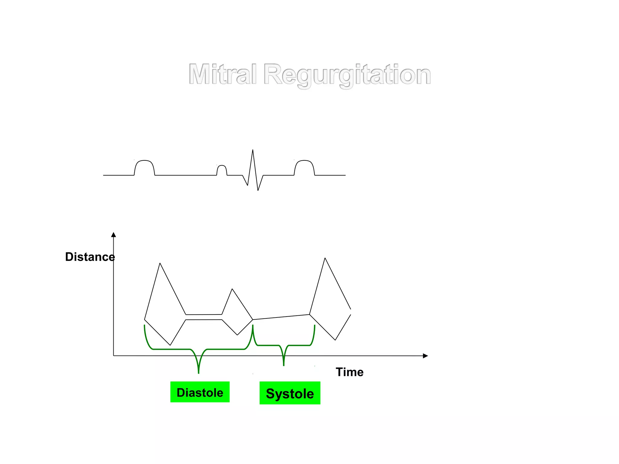 Distance
SystoleDiastole
Time
 