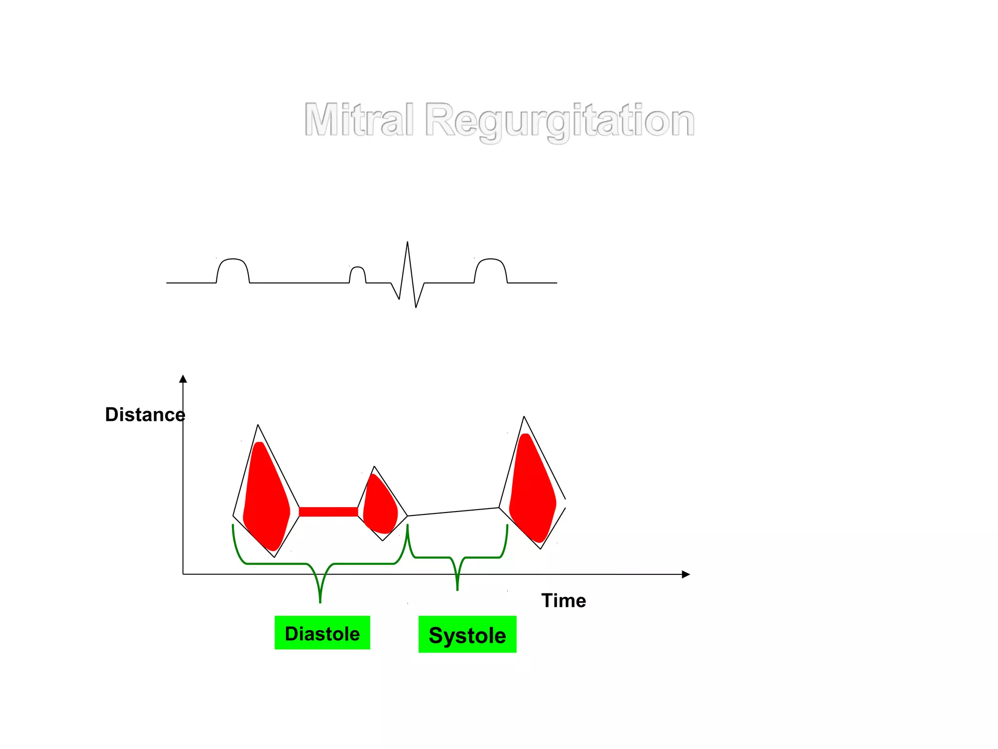 Distance
SystoleDiastole
Time
 