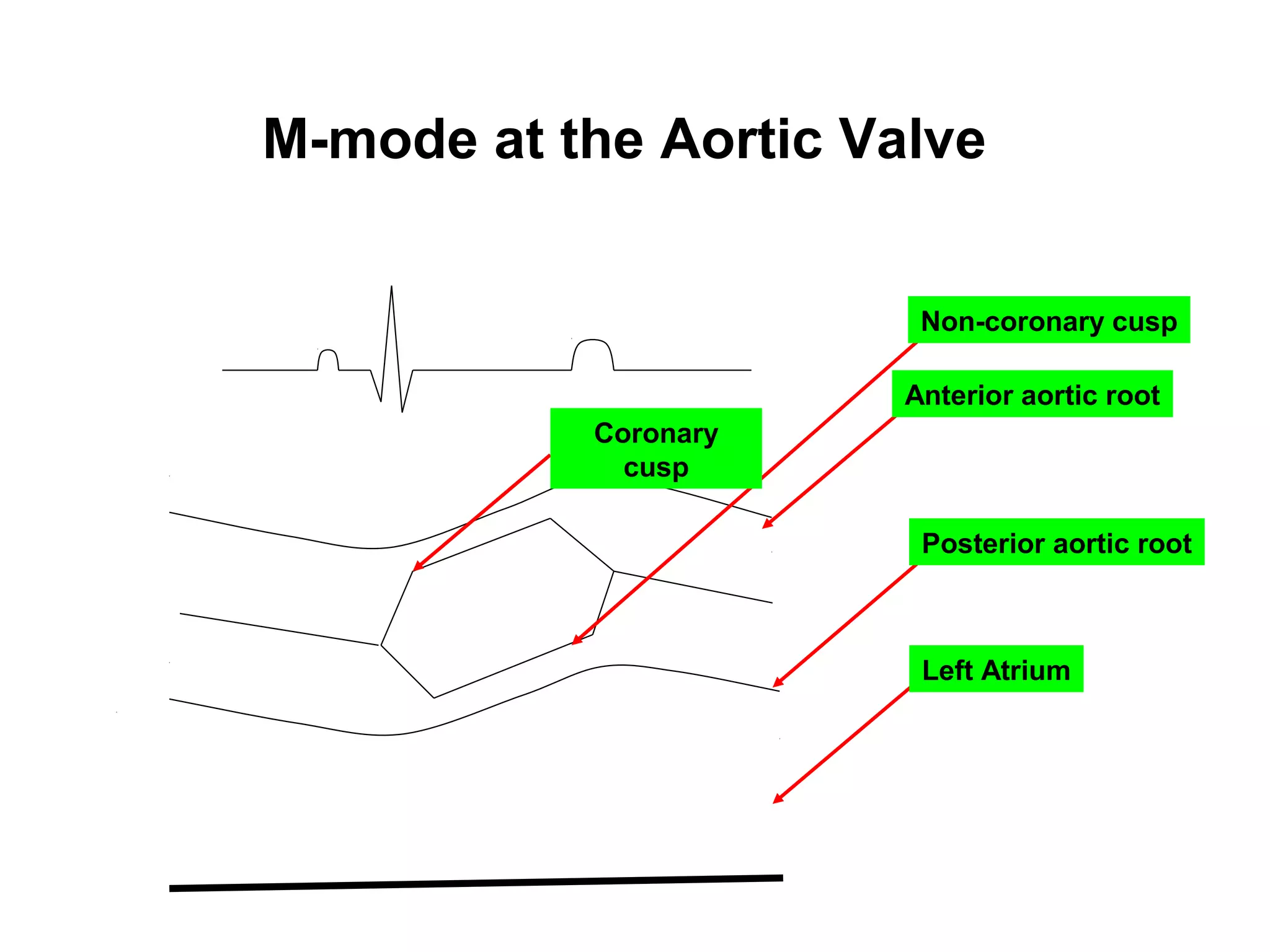 M-mode at the Aortic Valve
Coronary
cusp
Non-coronary cusp
Anterior aortic root
Posterior aortic root
Left Atrium
 