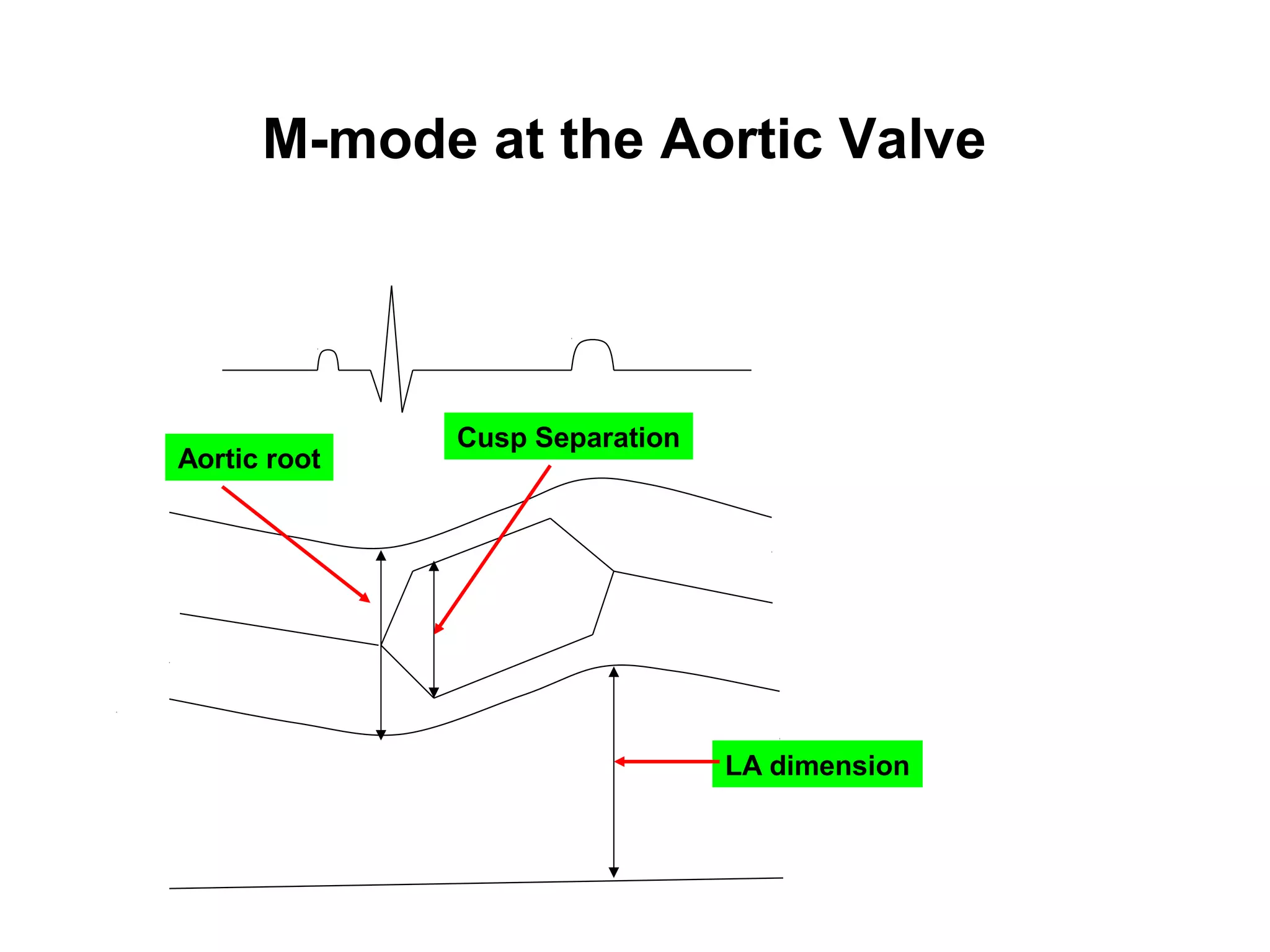 M-mode at the Aortic Valve
LA dimension
Cusp Separation
Aortic root
 