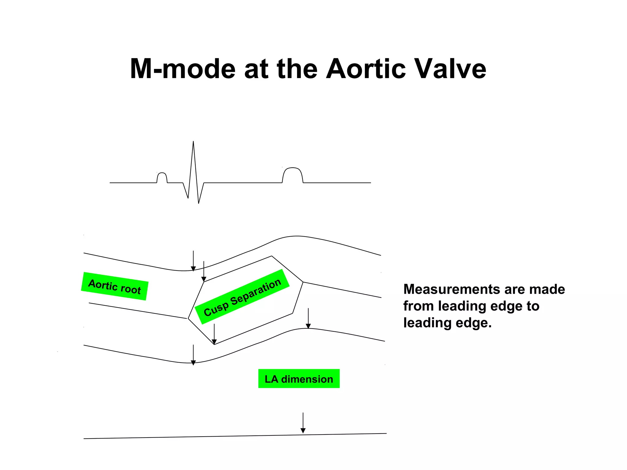 M-mode at the Aortic Valve
LA dimension
Cusp SeparationAortic root Measurements are made
from leading edge to
leading edge.
 