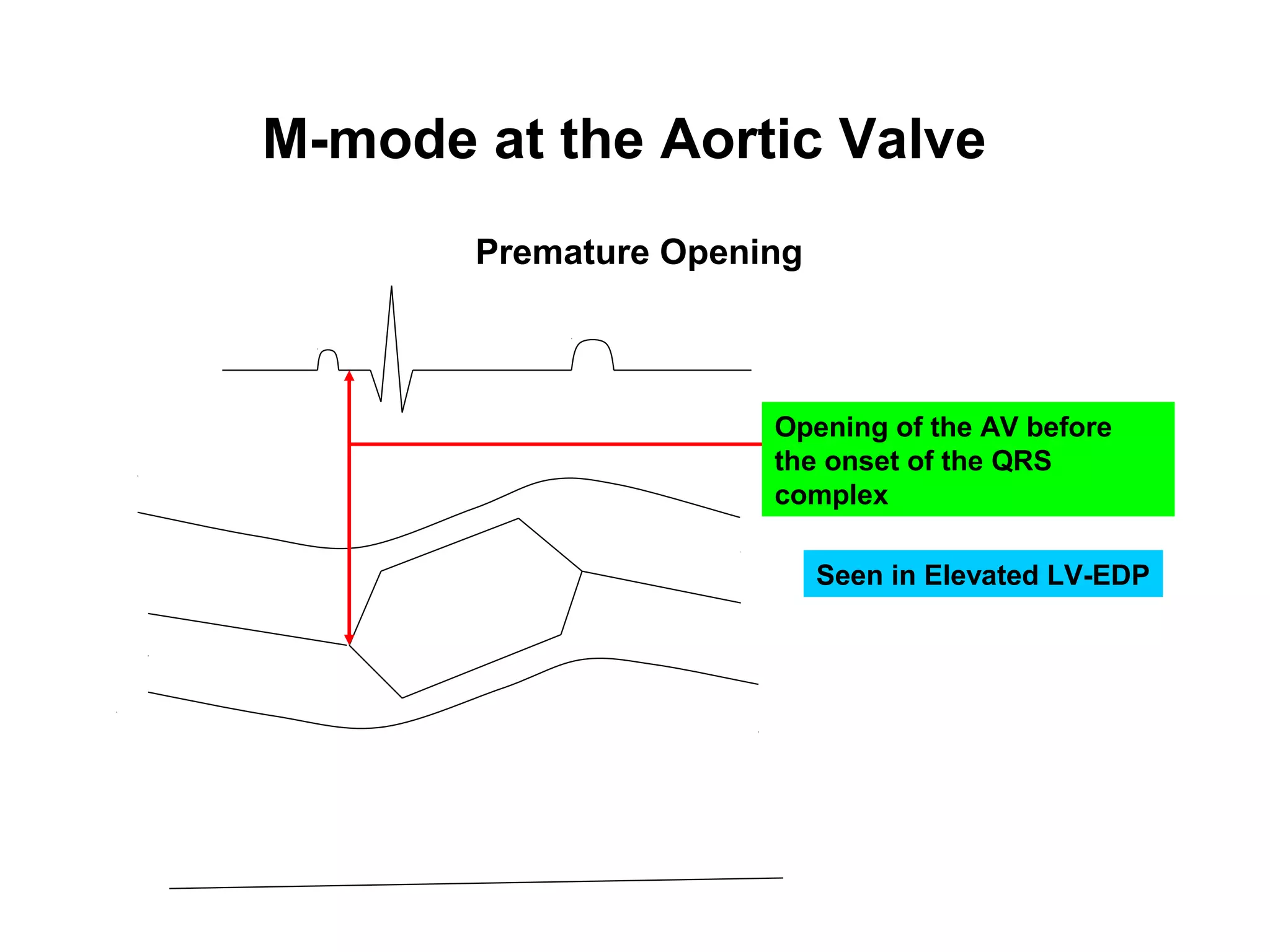 M-mode at the Aortic Valve
Premature Opening
Opening of the AV before
the onset of the QRS
complex
Seen in Elevated LV-EDP
 