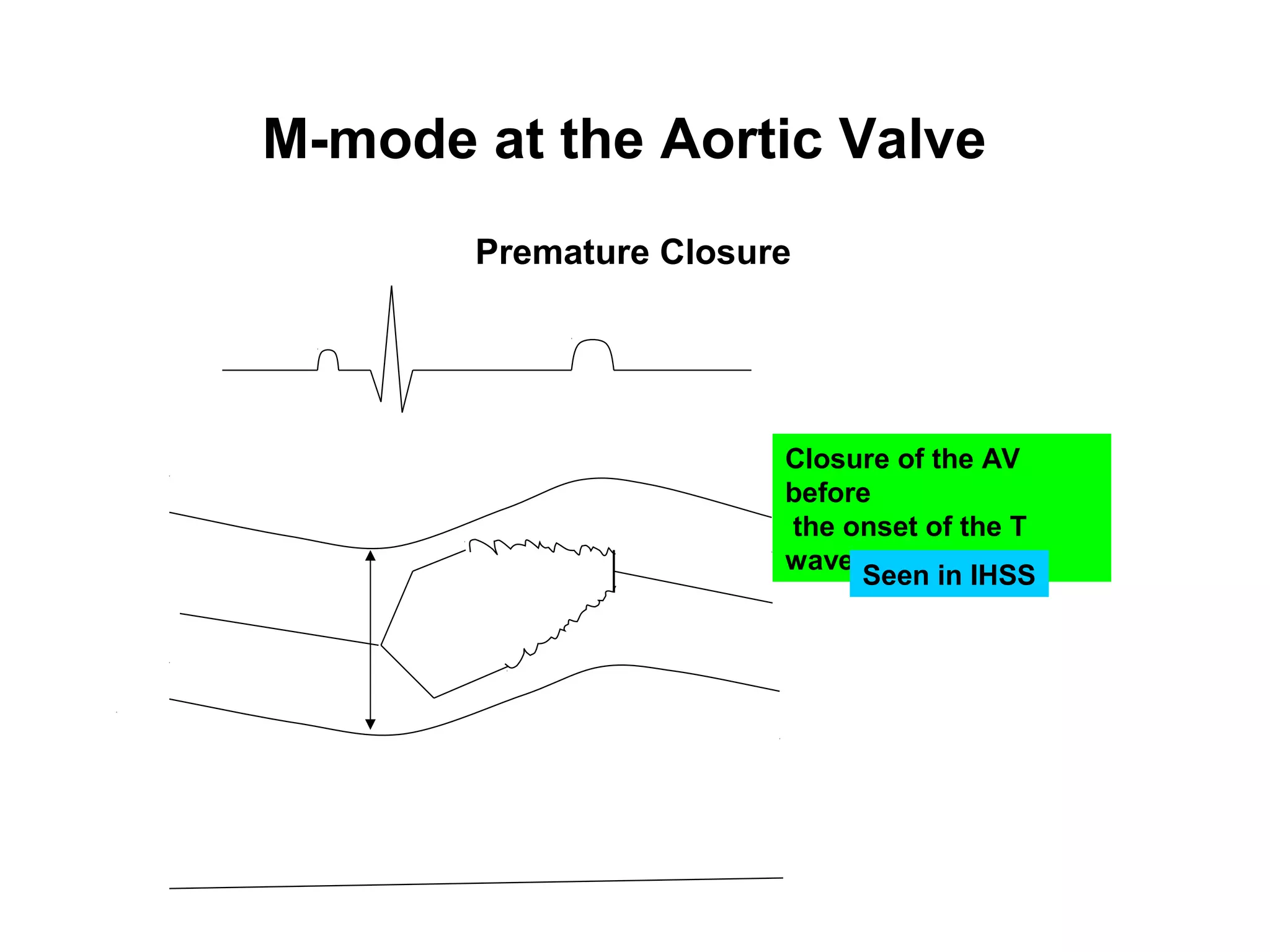 M-mode at the Aortic Valve
Premature Closure
Closure of the AV
before
the onset of the T
wave
Seen in IHSS
 