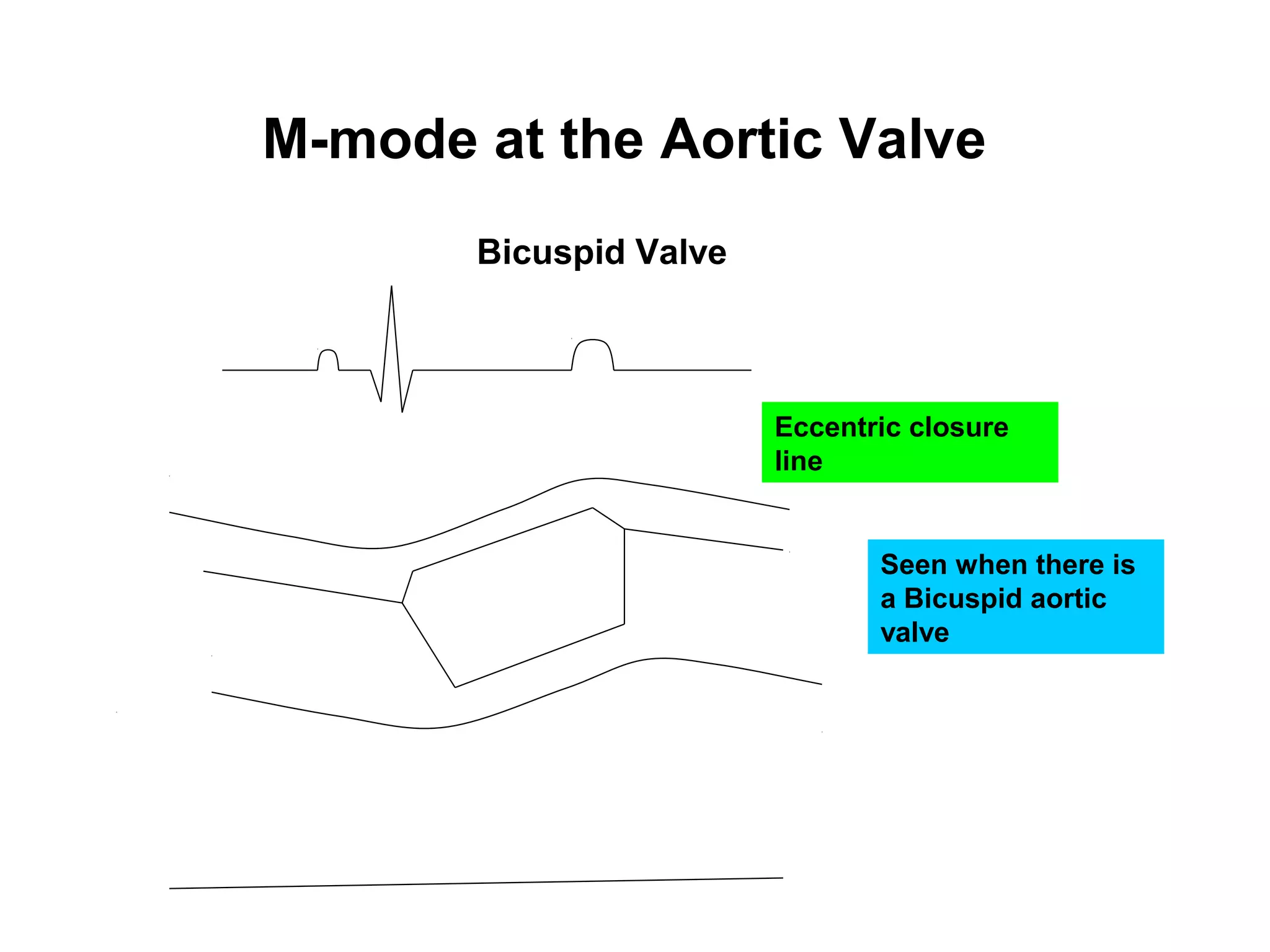 M-mode at the Aortic Valve
Bicuspid Valve
Eccentric closure
line
Seen when there is
a Bicuspid aortic
valve
 