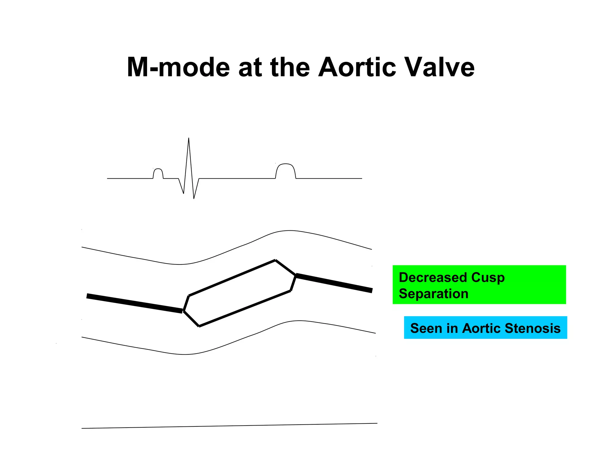 M-mode at the Aortic Valve
Decreased Cusp
Separation
Seen in Aortic Stenosis
 