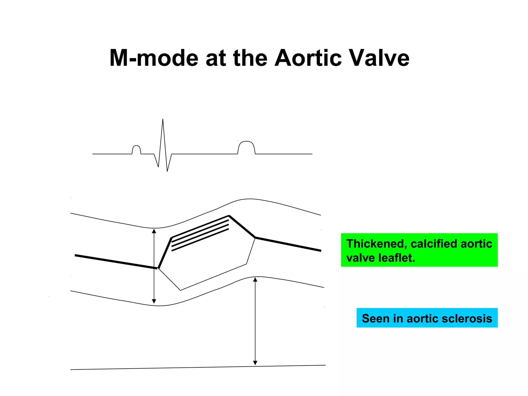M-mode at the Aortic Valve
Seen in aortic sclerosis
Thickened, calcified aortic
valve leaflet.
 