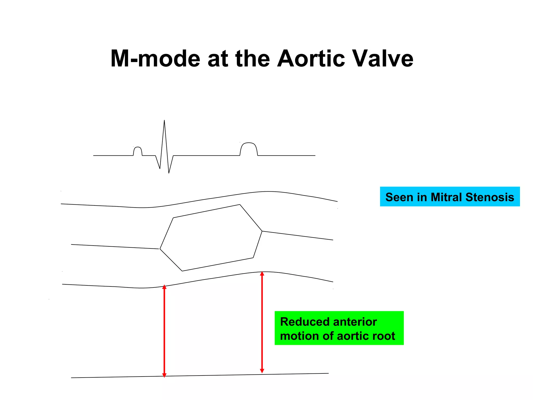 M-mode at the Aortic Valve
Seen in Mitral Stenosis
Reduced anterior
motion of aortic root
 