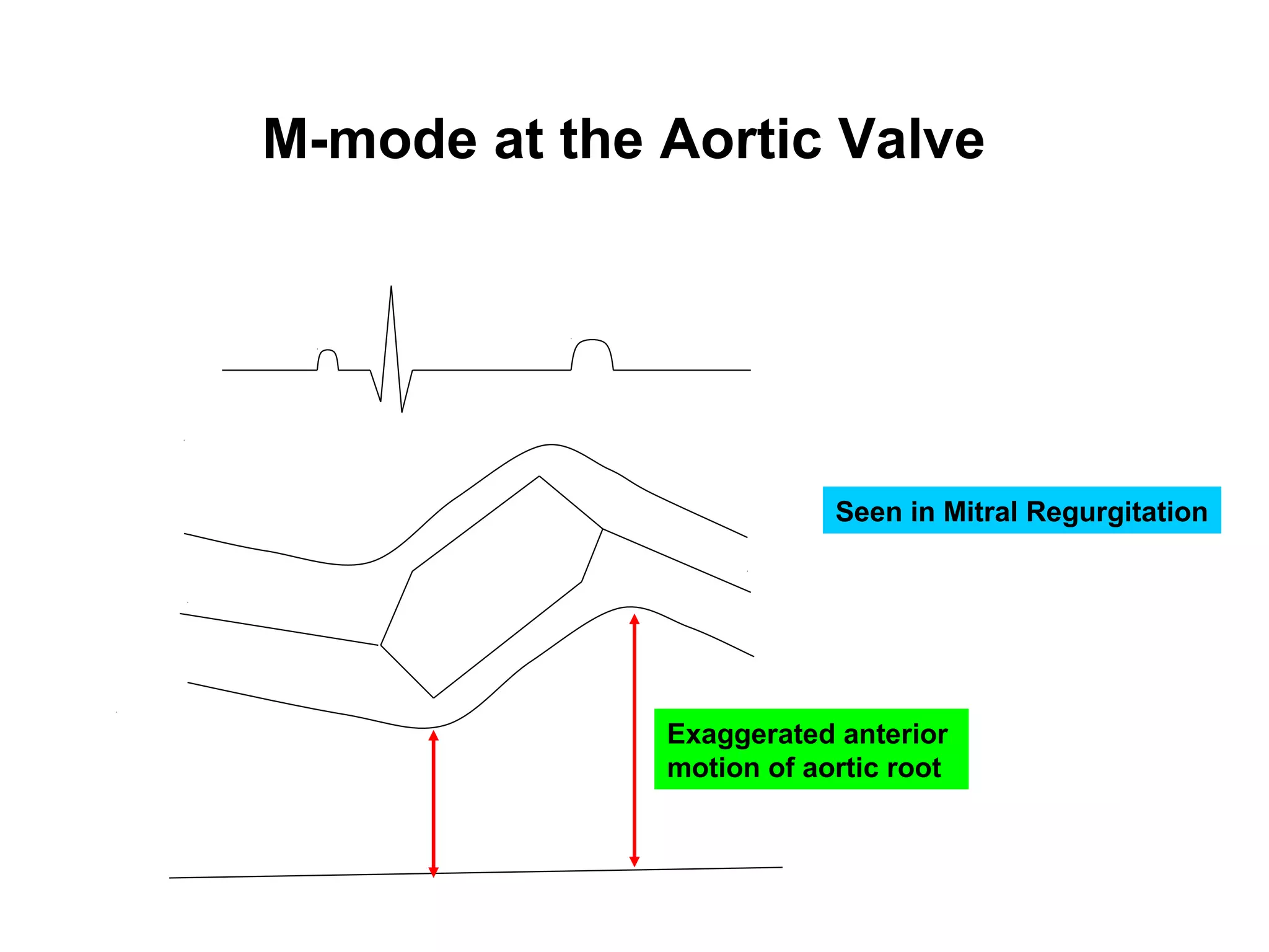 M-mode at the Aortic Valve
Exaggerated anterior
motion of aortic root
Seen in Mitral Regurgitation
 