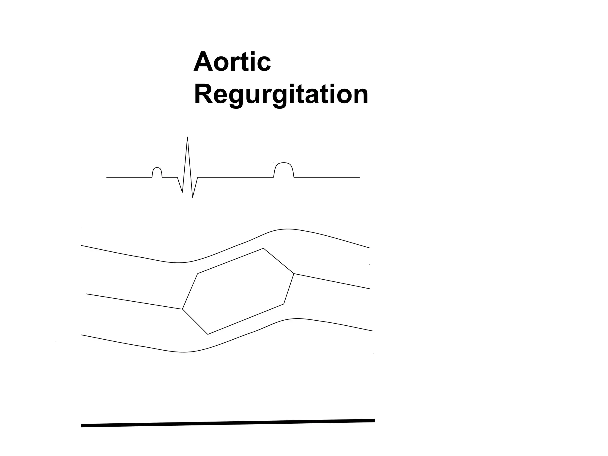Aortic
Regurgitation
 