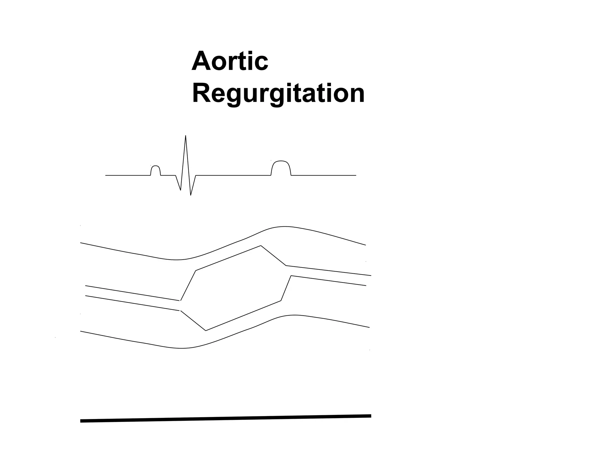 Aortic
Regurgitation
 