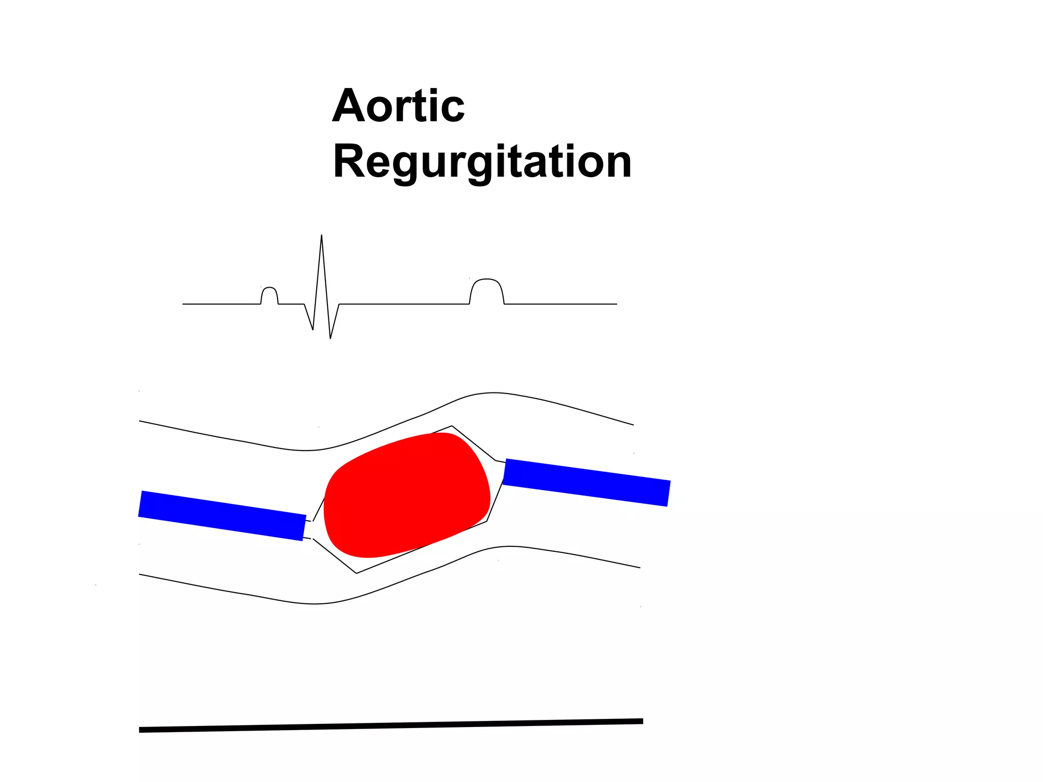 Aortic
Regurgitation
 