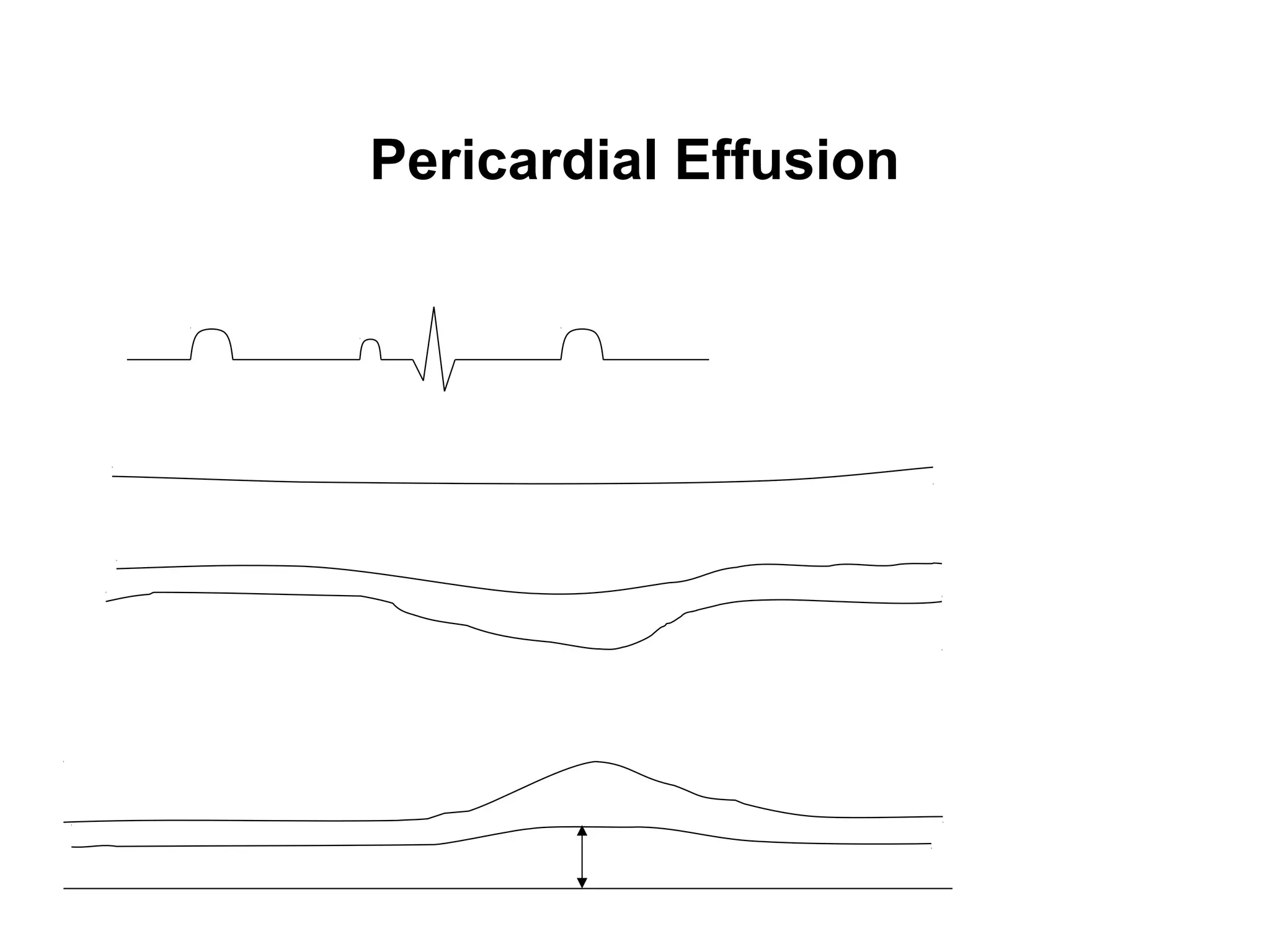 Pericardial Effusion
 