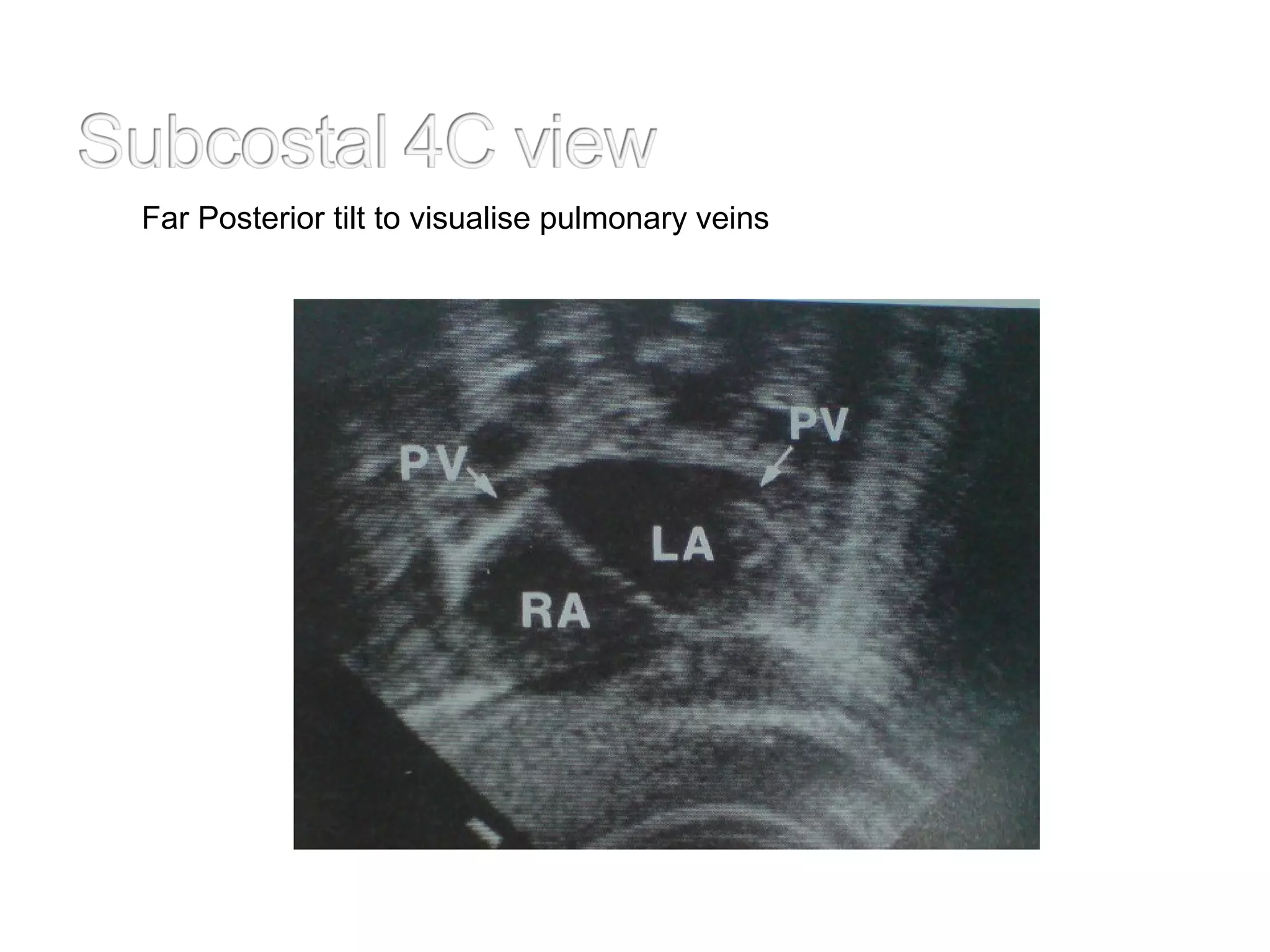 Far Posterior tilt to visualise pulmonary veins
 