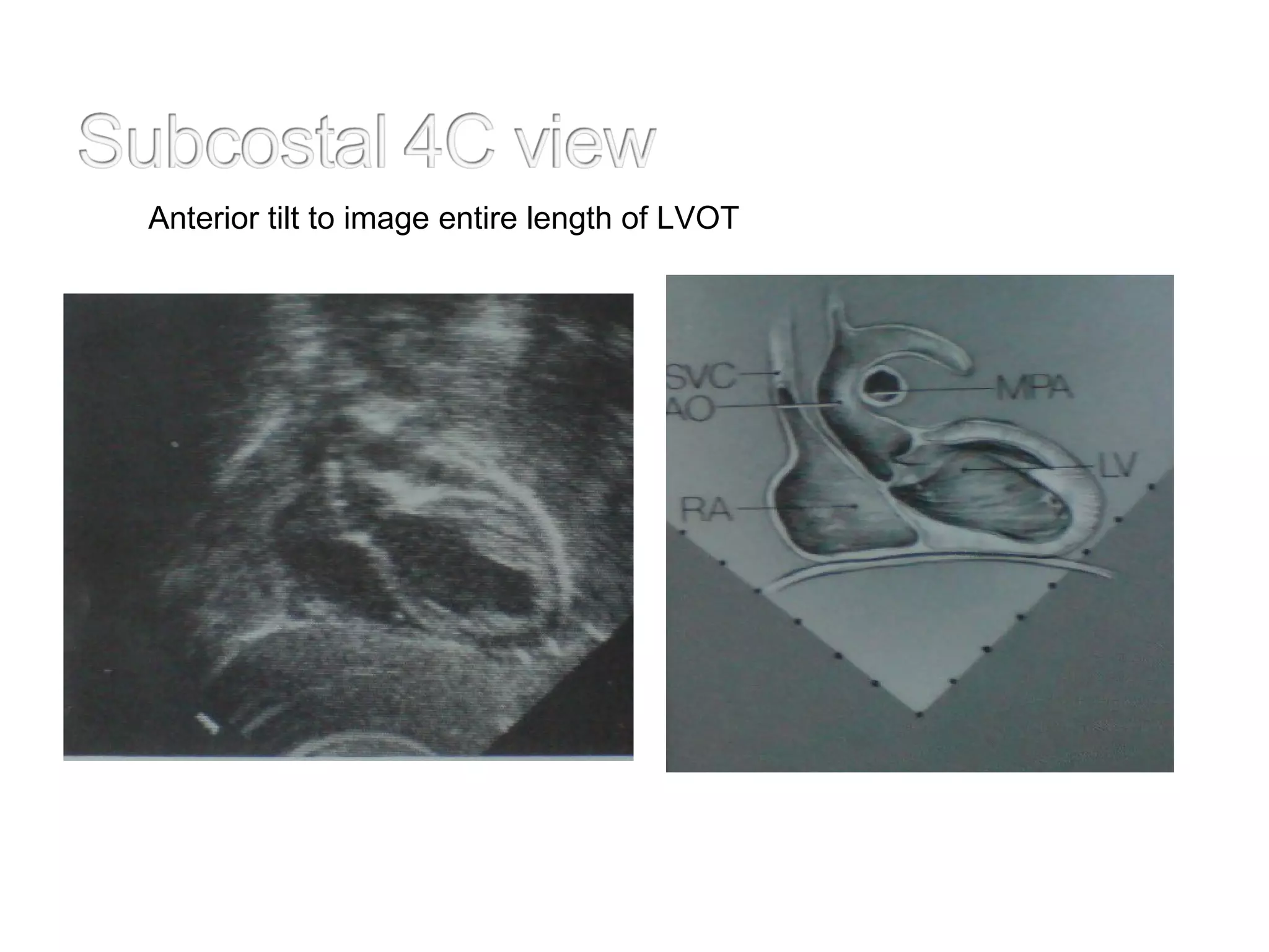 Anterior tilt to image entire length of LVOT
 