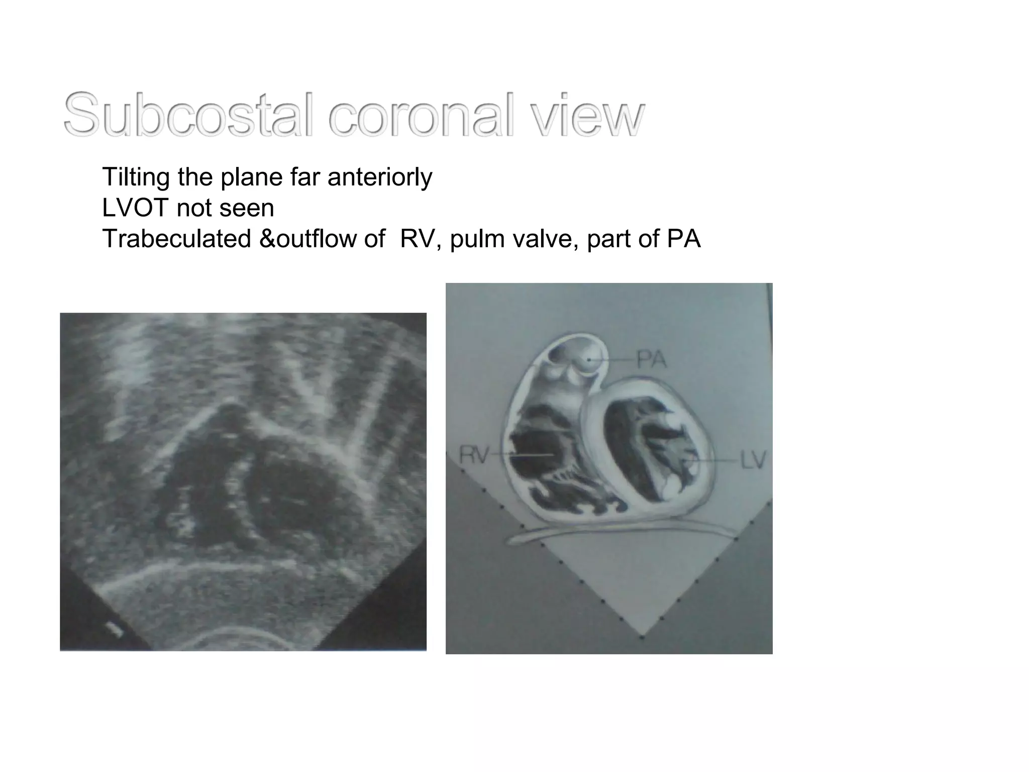 Tilting the plane far anteriorly
LVOT not seen
Trabeculated &outflow of RV, pulm valve, part of PA
 