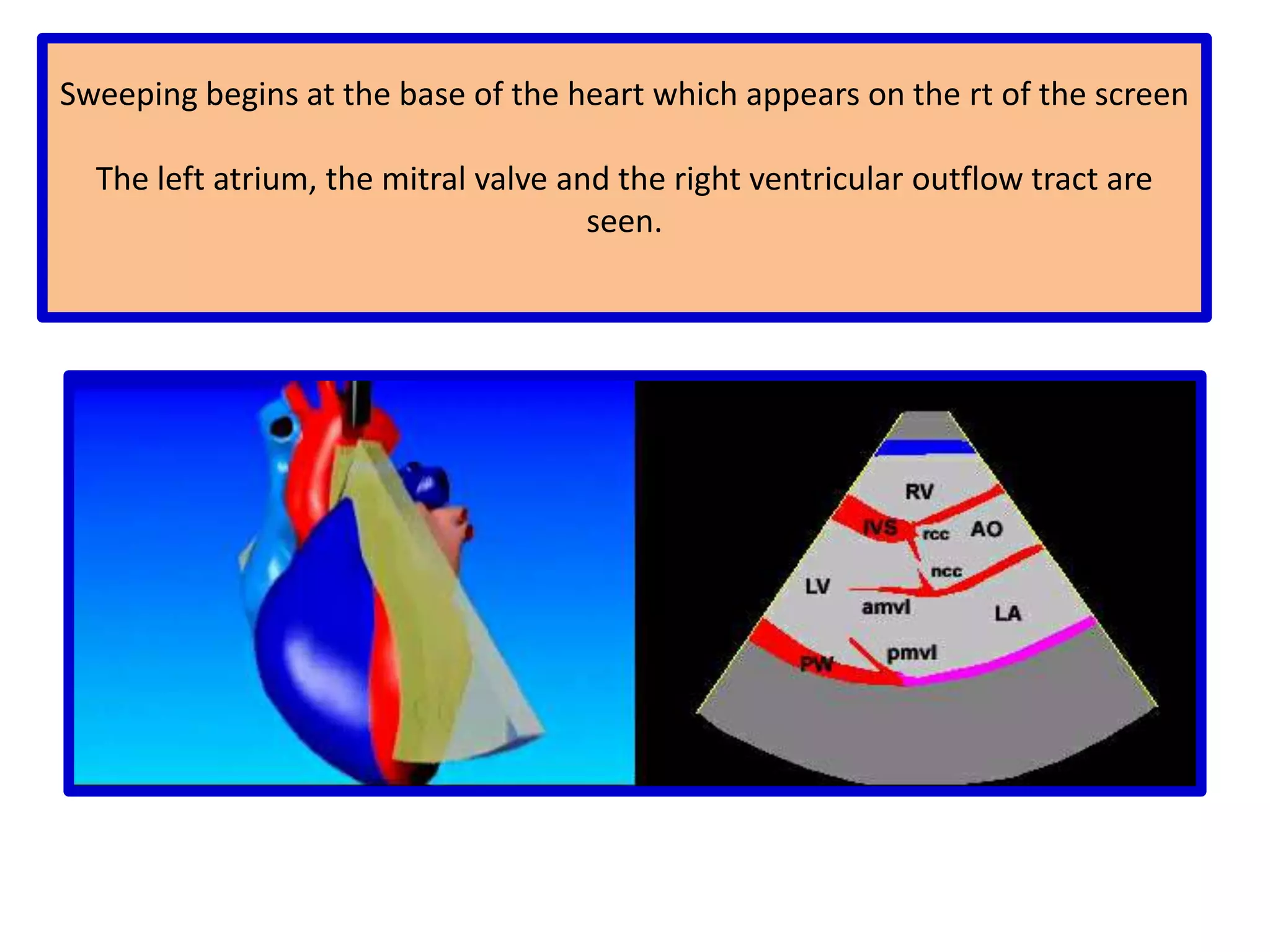 uses broadband transducers that receive double the transmitted frequencyWhen compared to conventional imaging, it reduces variations in ultrasound intensity along endocardial and myocardial surfaces, enhancing these structures of particular benefit for patients in whom optimal echocardiographic images are technically difficult to obtainharmonic imaging improves interphase definition