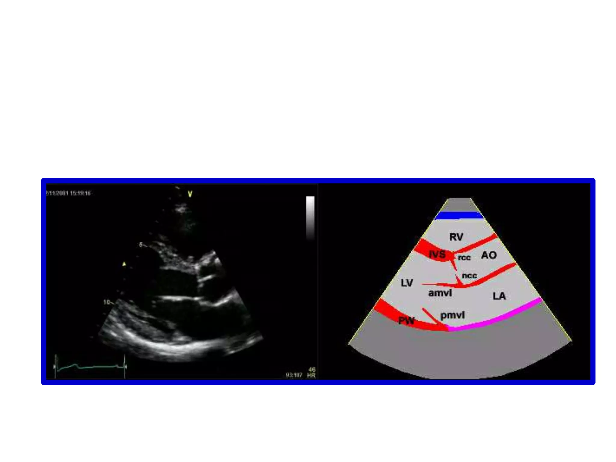 2. IMAGING MODALITIESTwo dimensional (2-D) imaging :A 2D image is generated from data obtained mechanically (mechanical transducer) or electronically (phased-array transducer)The signal received undergoes a complex manipulation to form the final image displayed on the monitor including signal amplification, time-gain compensation, filtering, compression and rectification.M-mode:Motion or "M"-mode echocardiography is among the earliest forms of cardiac ultrasound The very high temporal resolution by M-mode imaging permits:identification of subtle abnormalities such as fluttering of the anterior mitral leaflet due to aortic insufficiency or movement of a vegetation. dimensional measurements or changes, such as chamber size and endocardial thickening, can be readily appreciated