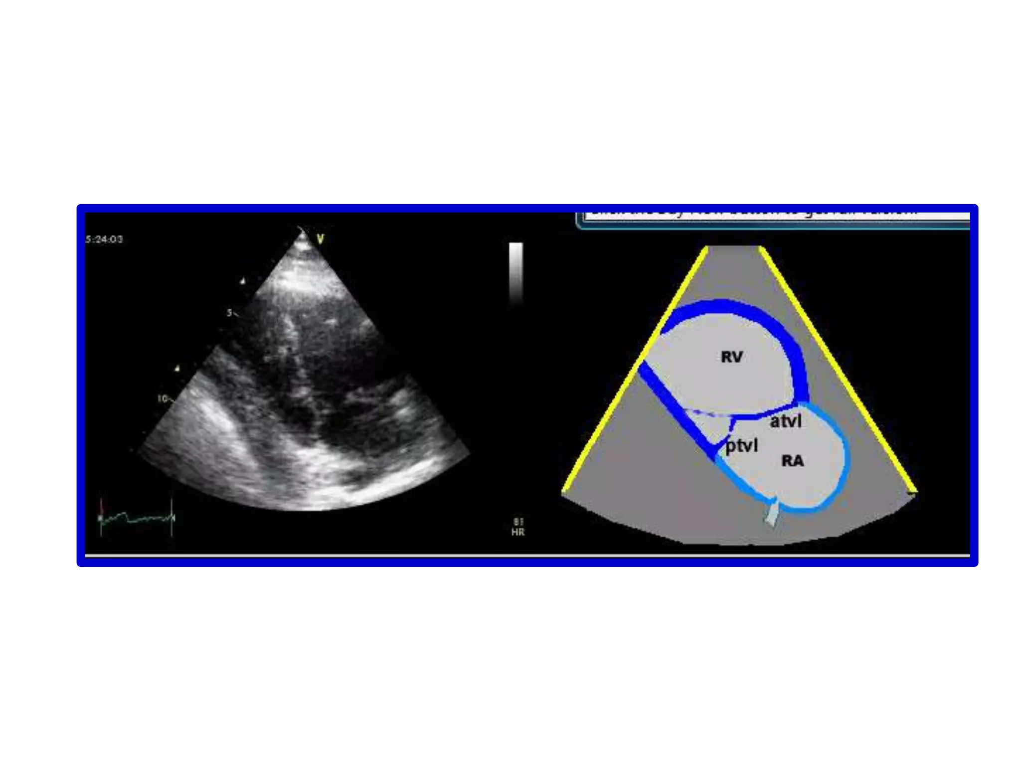 OPTIMIZATION OF 2-D IMAGESTechnical Factors ITRANSDUCER:High frequency increases backscatter and resolution but lacks depth penetration