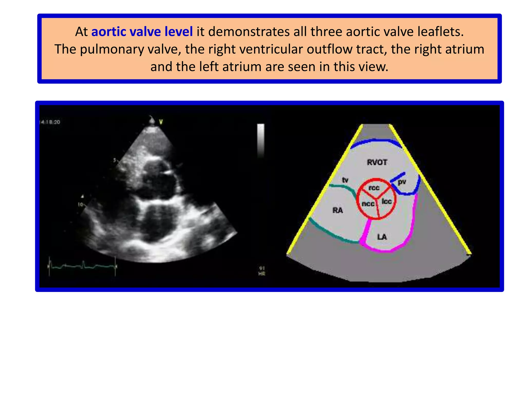 IMAGING PLANESThe long-axis plane is the plane perpendicular to the posterior and anterior surfaces of the body and parallel to the long axis of the heart