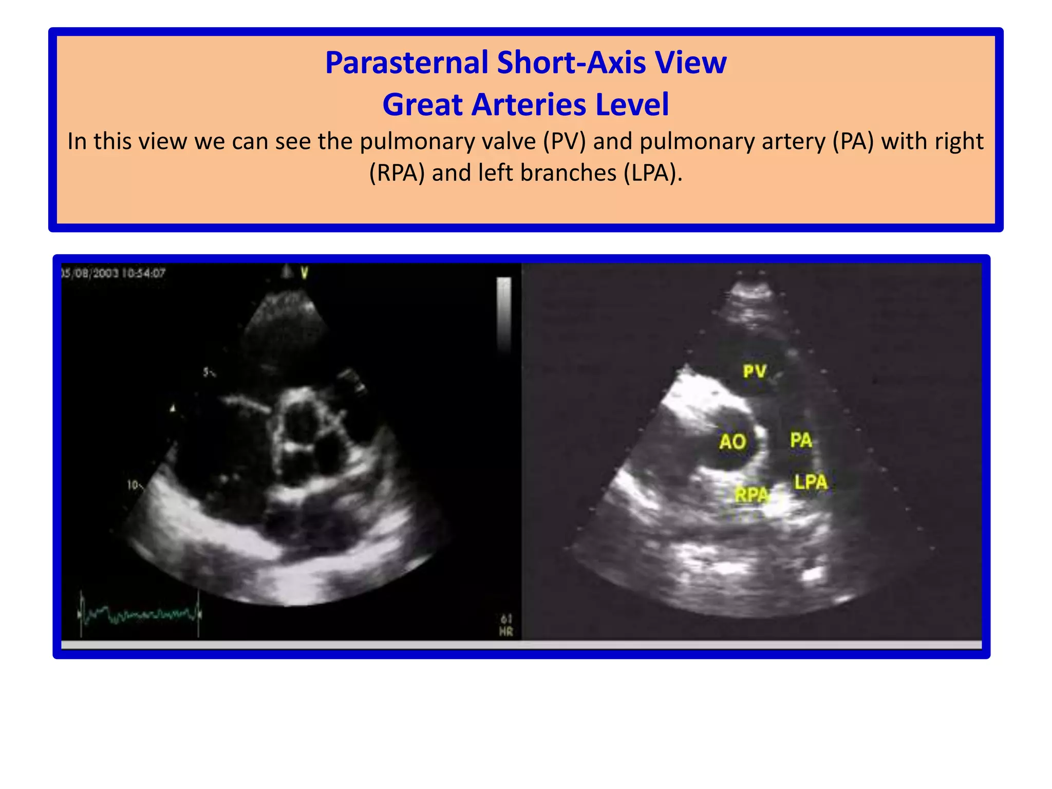Sweeping begins at the base of the heart which appears on the rt of the screenThe left atrium, the mitral valve and the right ventricular outflow tract are seen.