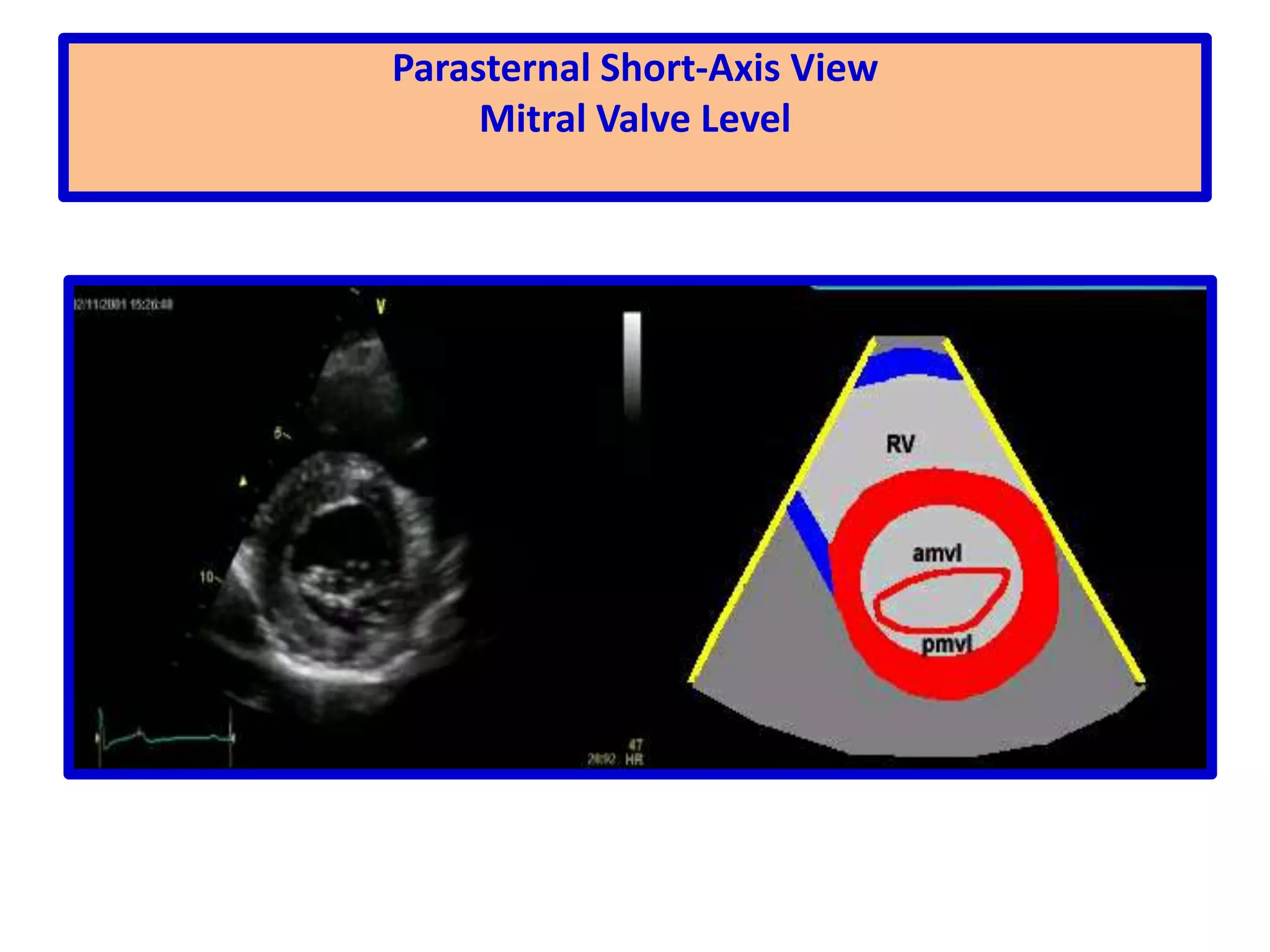 Parasternal WindowRight Long-Axis ViewSweeping begins at the right atrium which is on the right of the screen. In this view we can see the right atrium and the right ventricle, with the tricuspid valve in between