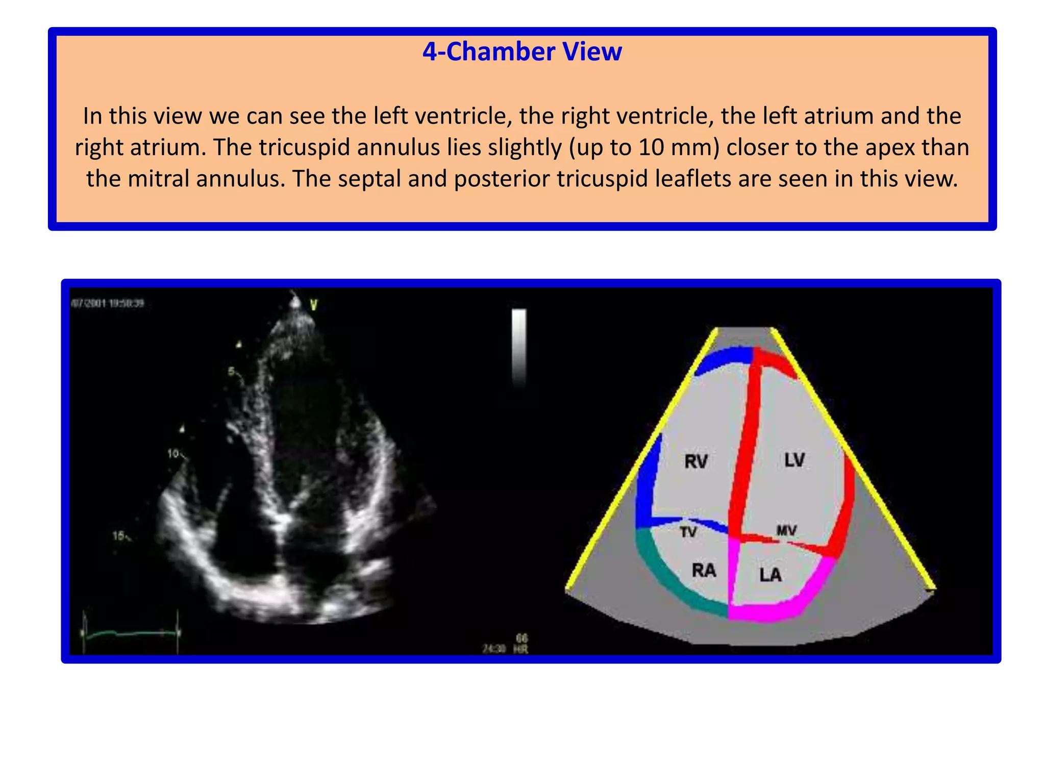                        Parasternal Short-Axis ViewsObtained from the parasternal window by rotating the transducer clockwise by 90ºHence, the image index marker is pointed toward the patient´s right supraclavicularfossa. A series of sweeps transect the heart from the base to the apex by changes in transducer position and angulation. There are three characteristic levels: 1) great vessels, 2) mitral valve, 3) ventricles.