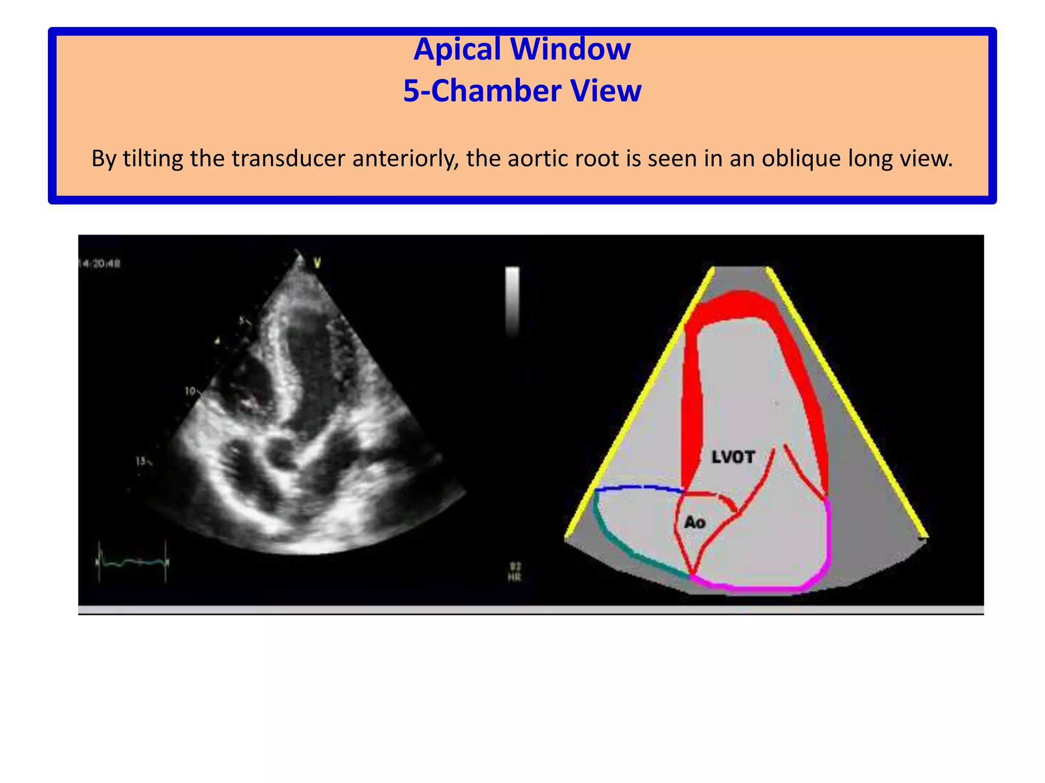 Parasternal Short-Axis ViewGreat Arteries LevelSweeping begins at the left edge of the atrium which appears on the right of the screen