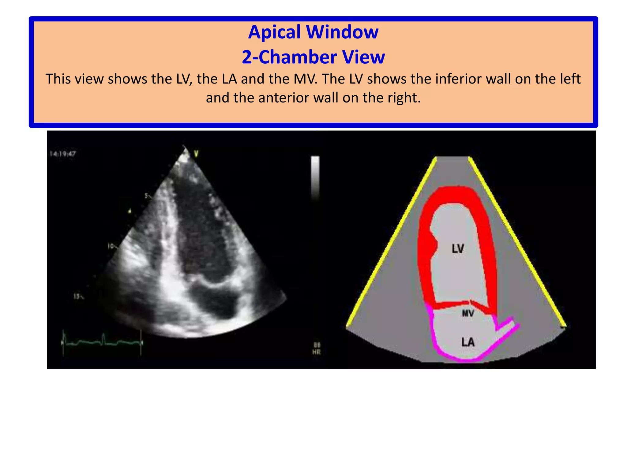 Parasternal Short-Axis ViewGreat Arteries LevelIn this view we can see the pulmonary valve (PV) and pulmonary artery (PA) with right (RPA) and left branches (LPA).