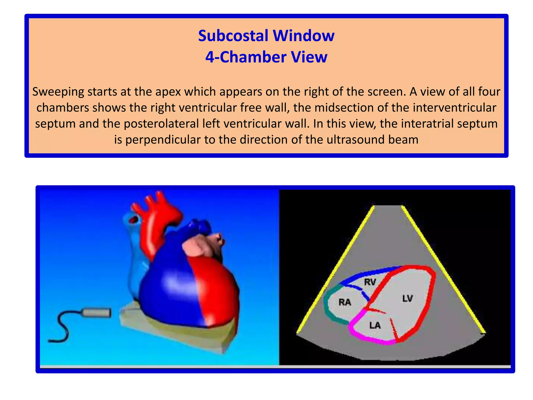 Parasternal Short-Axis ViewMitral Valve LevelThe anterior and posterior mitral leaflets are seen as they open in diastole and close in systole