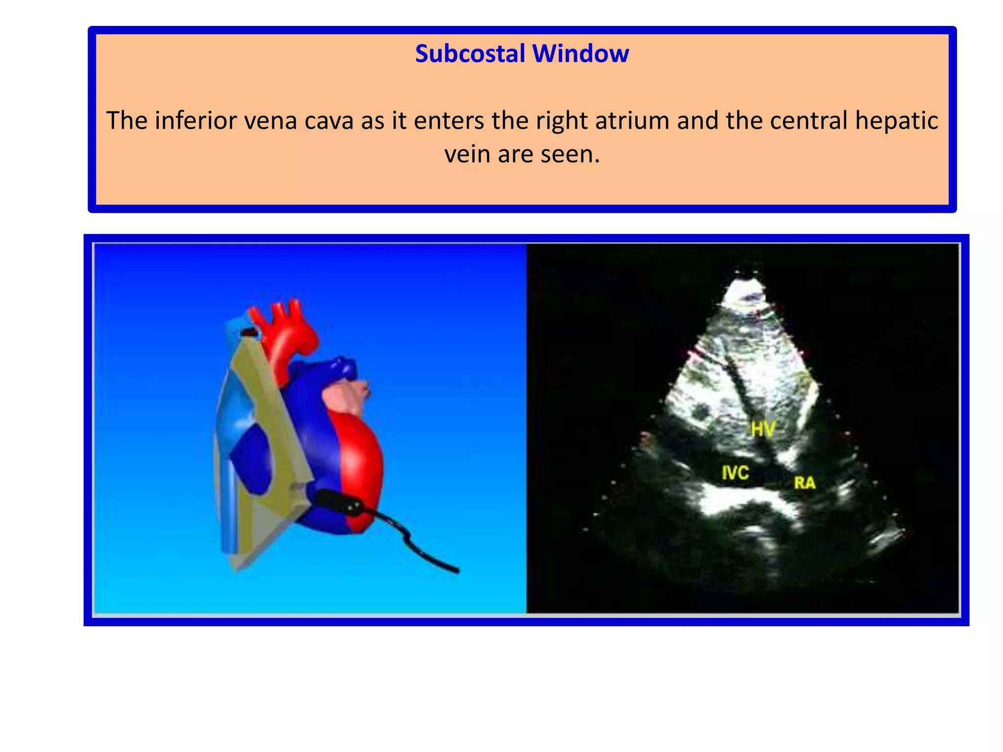 Parasternal Short-Axis ViewMitral Valve Level