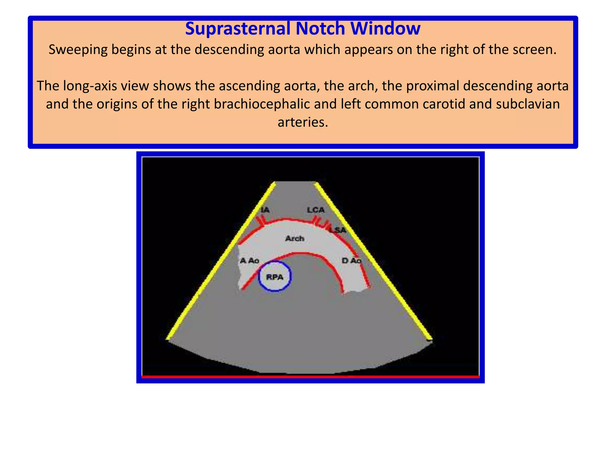 The four-chamber plane is the plane that runs parallel to the posterior and anterior surfaces of the body and transects the heart from its apex to its base encompassing all four cardiac chambers