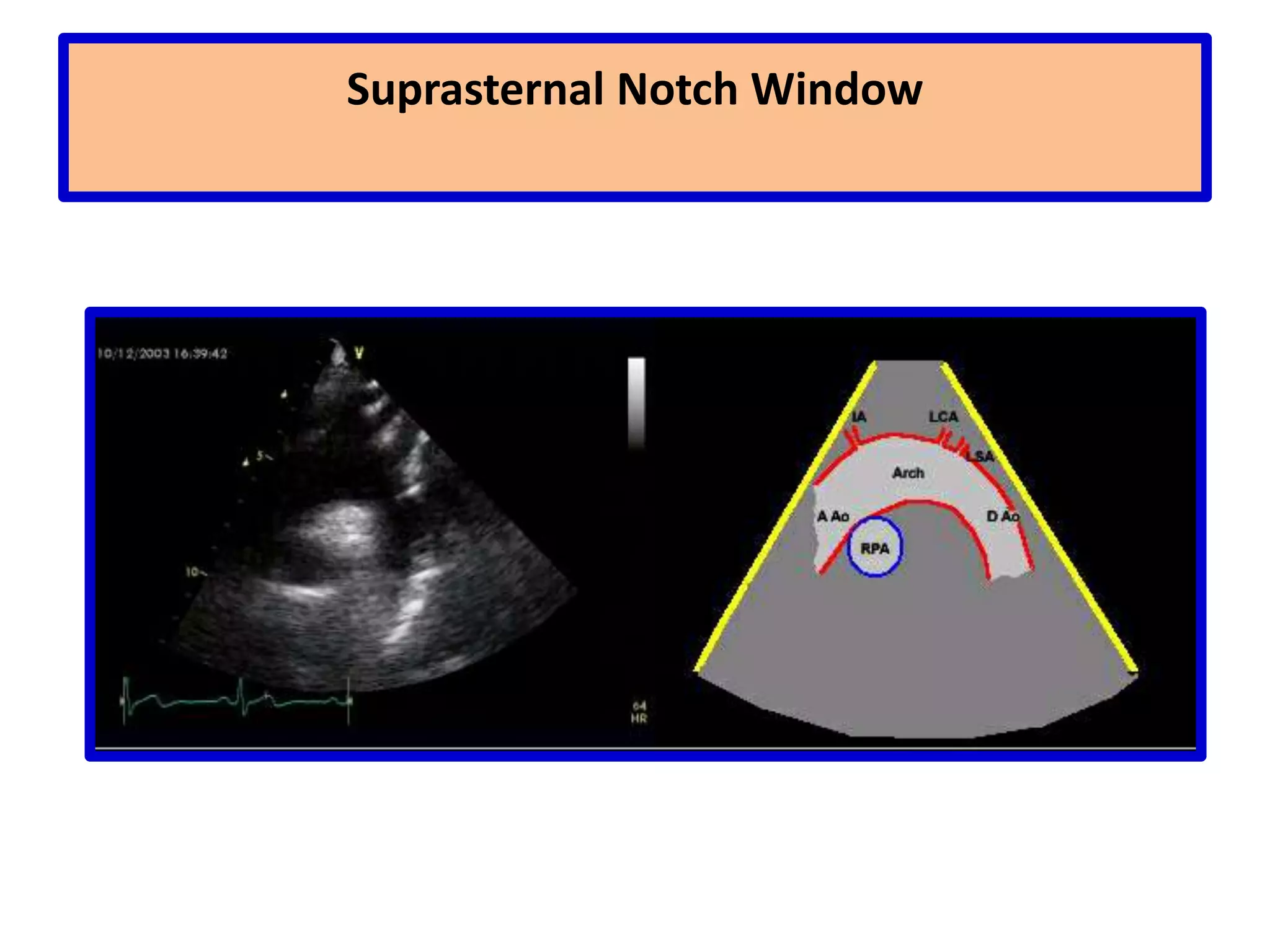 Apical WindowSweeping begins at the left edge of the heart which appears on the right of the screen.