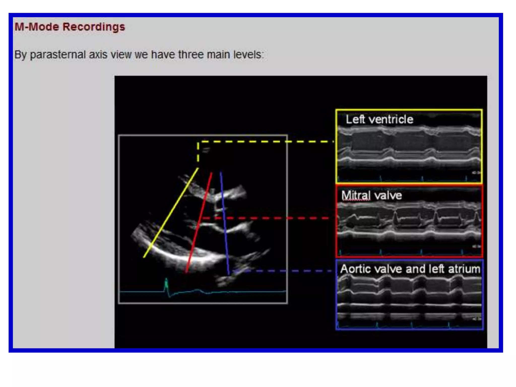 Apical Window5-Chamber ViewBy tilting the transducer anteriorly, the aortic root is seen in an oblique long view.